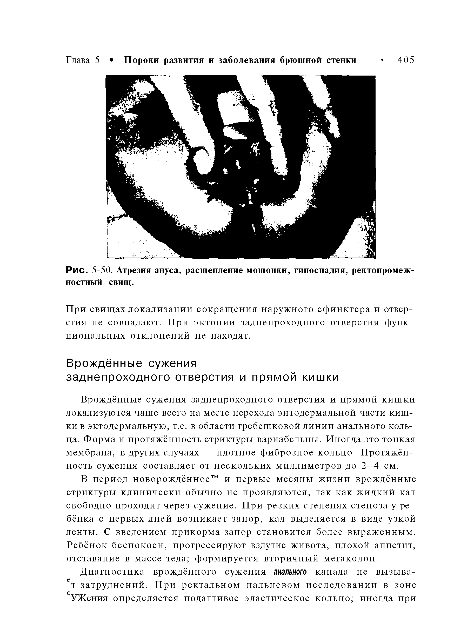 Рис. 5-50. Атрезия ануса, расщепление мошонки, гипоспадия, ректопромеж-ностный свищ.