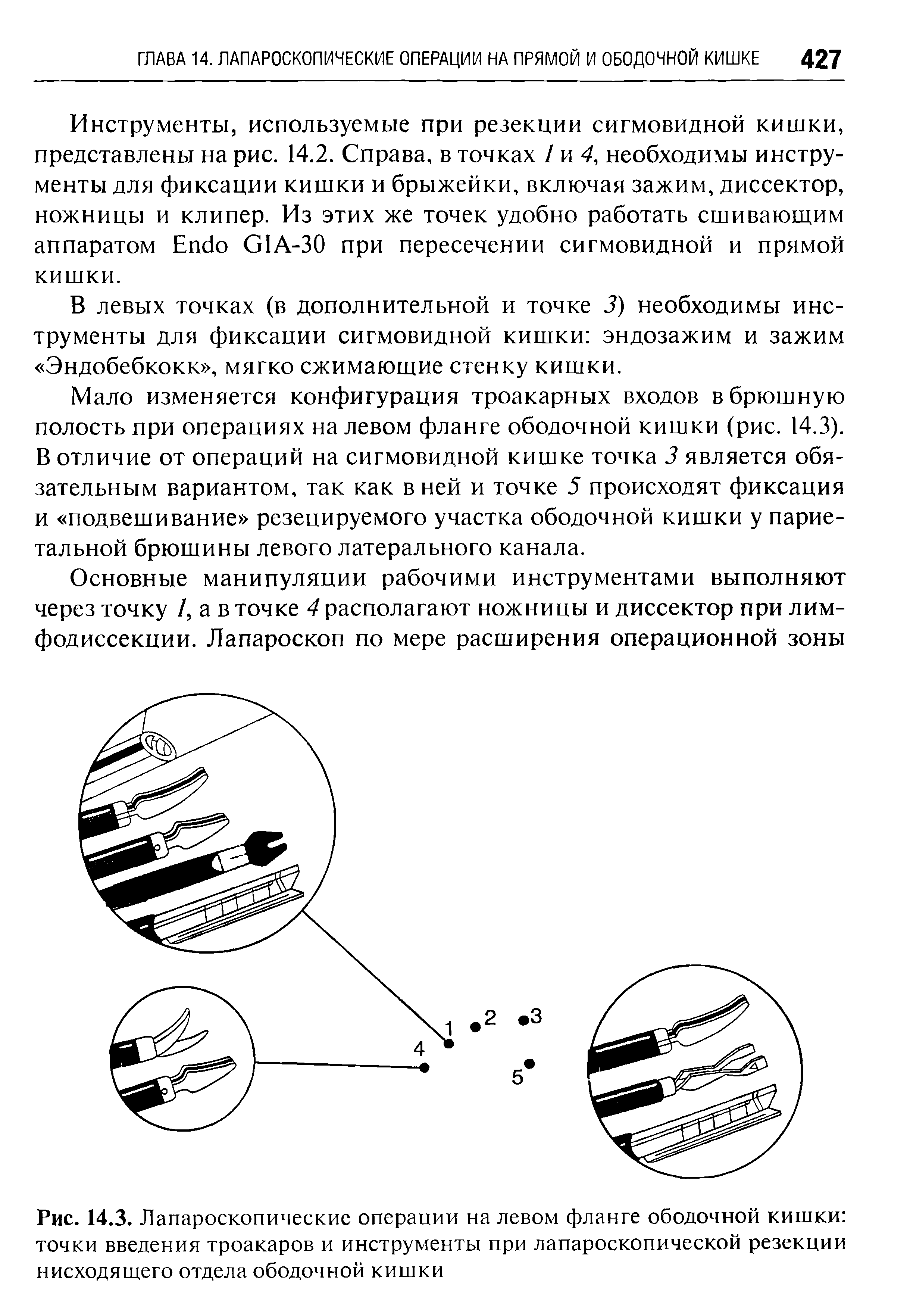 Рис. 14.3. Лапароскопические операции на левом фланге ободочной кишки точки введения троакаров и инструменты при лапароскопической резекции нисходящего отдела ободочной кишки...