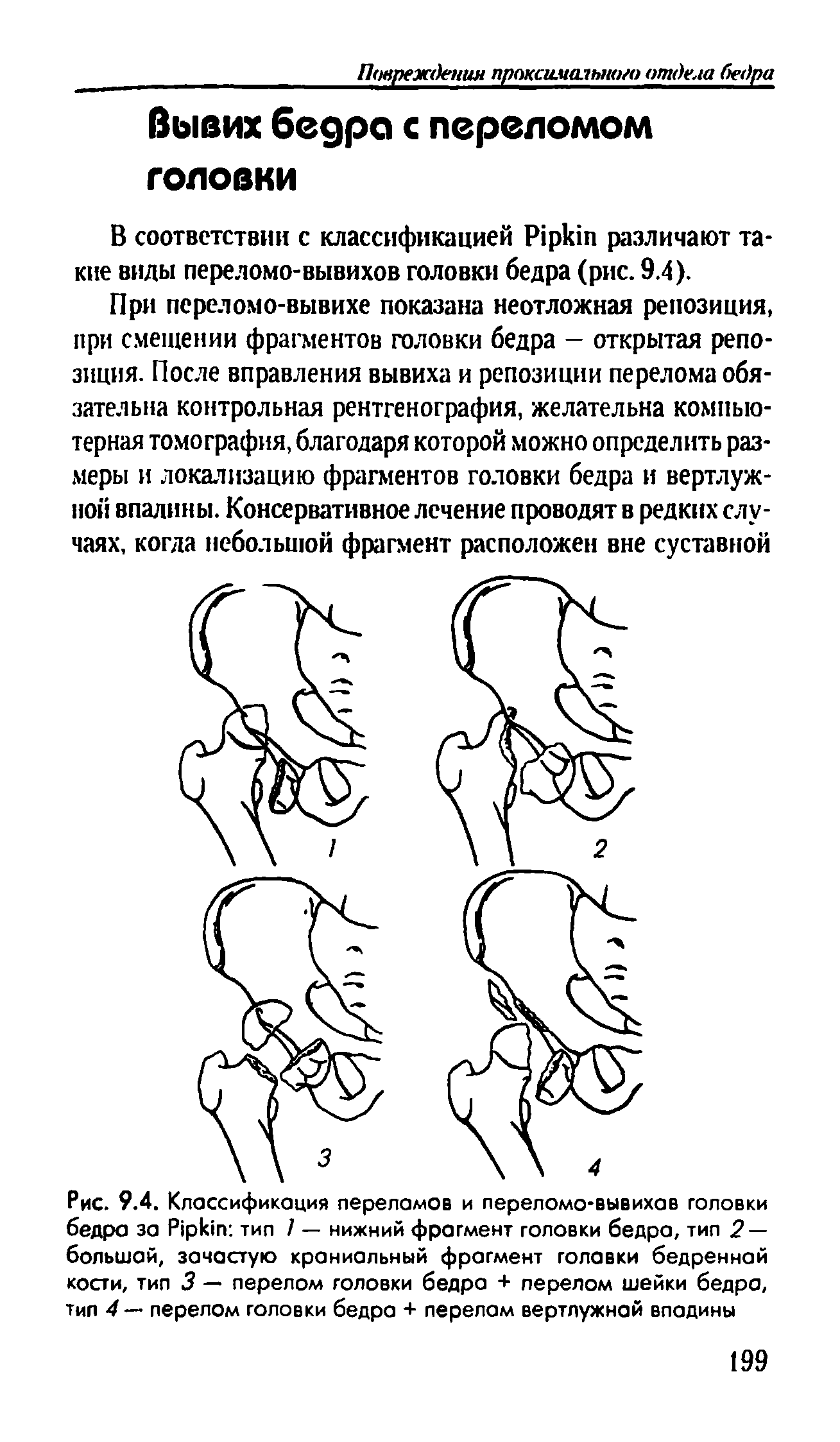 Рис. 9.4. Классификация переломов и переломо-вывихав головки бедра за P тип / — нижний фрагмент головки бедра, тип 2 — большой, зачастую краниальный фрагмент головки бедренной кости, тип 3 — перелом головки бедра + перелом шейки бедра, тип 4 — перелом головки бедра + перелом вертлужной впадины...