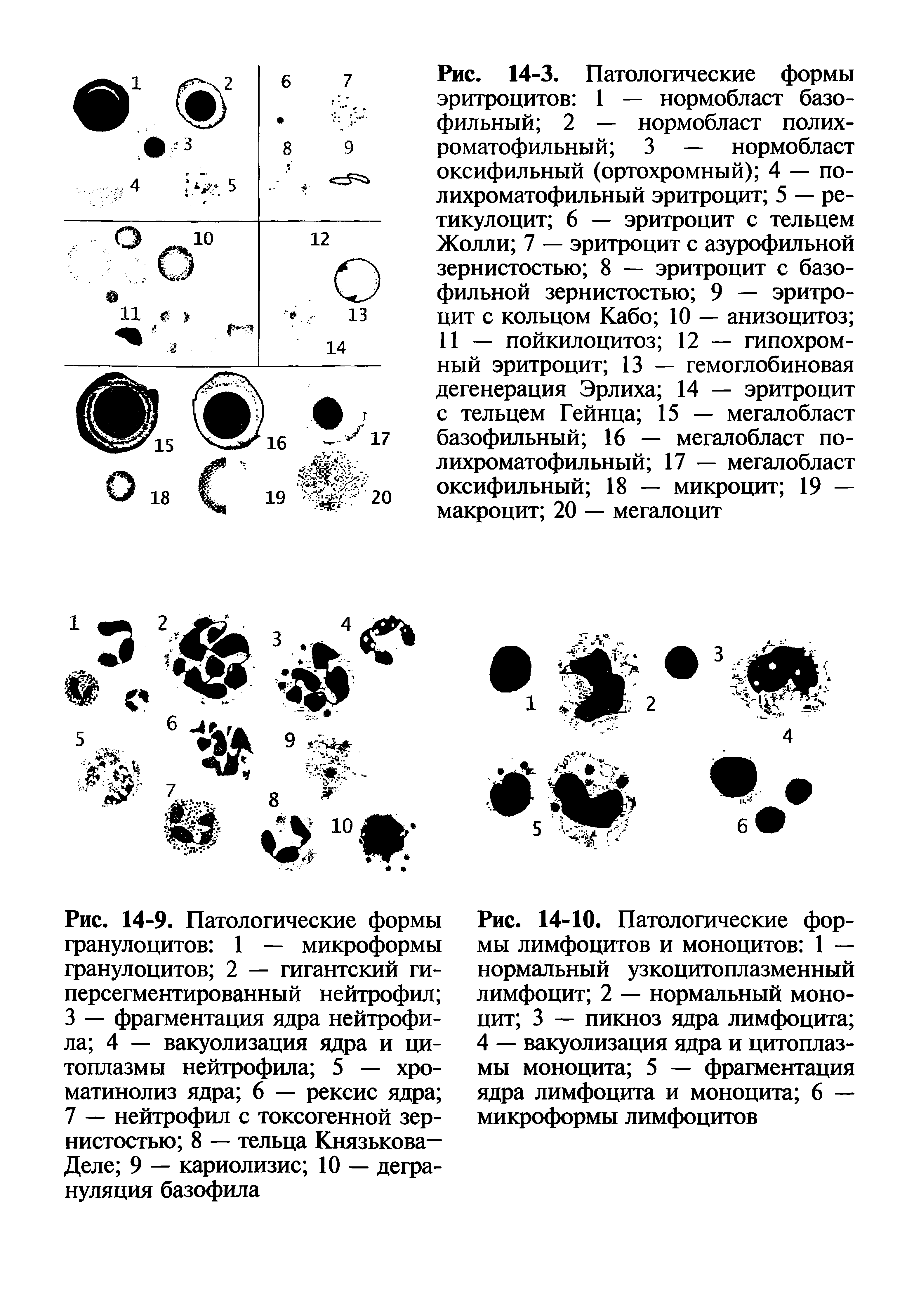 Рис. 14-10. Патологические формы лимфоцитов и моноцитов 1 — нормальный узкоцитоплазменный лимфоцит 2 — нормальный моноцит 3 — пикноз ядра лимфоцита 4 — вакуолизация ядра и цитоплазмы моноцита 5 — фрагментация ядра лимфоцита и моноцита 6 — микроформы лимфоцитов...