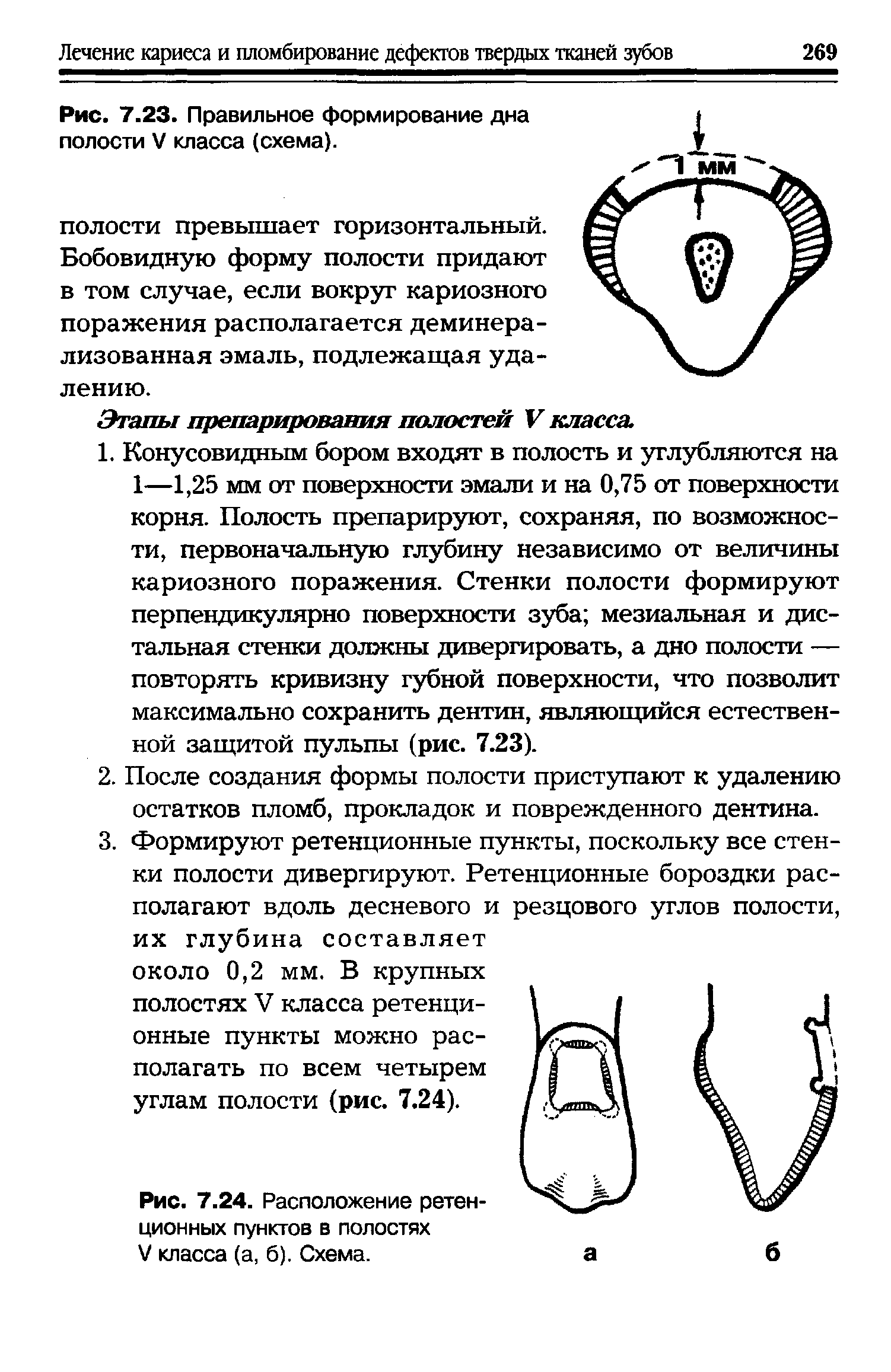 Рис. 7.24. Расположение ретенционных пунктов в полостях V класса (а, б). Схема.