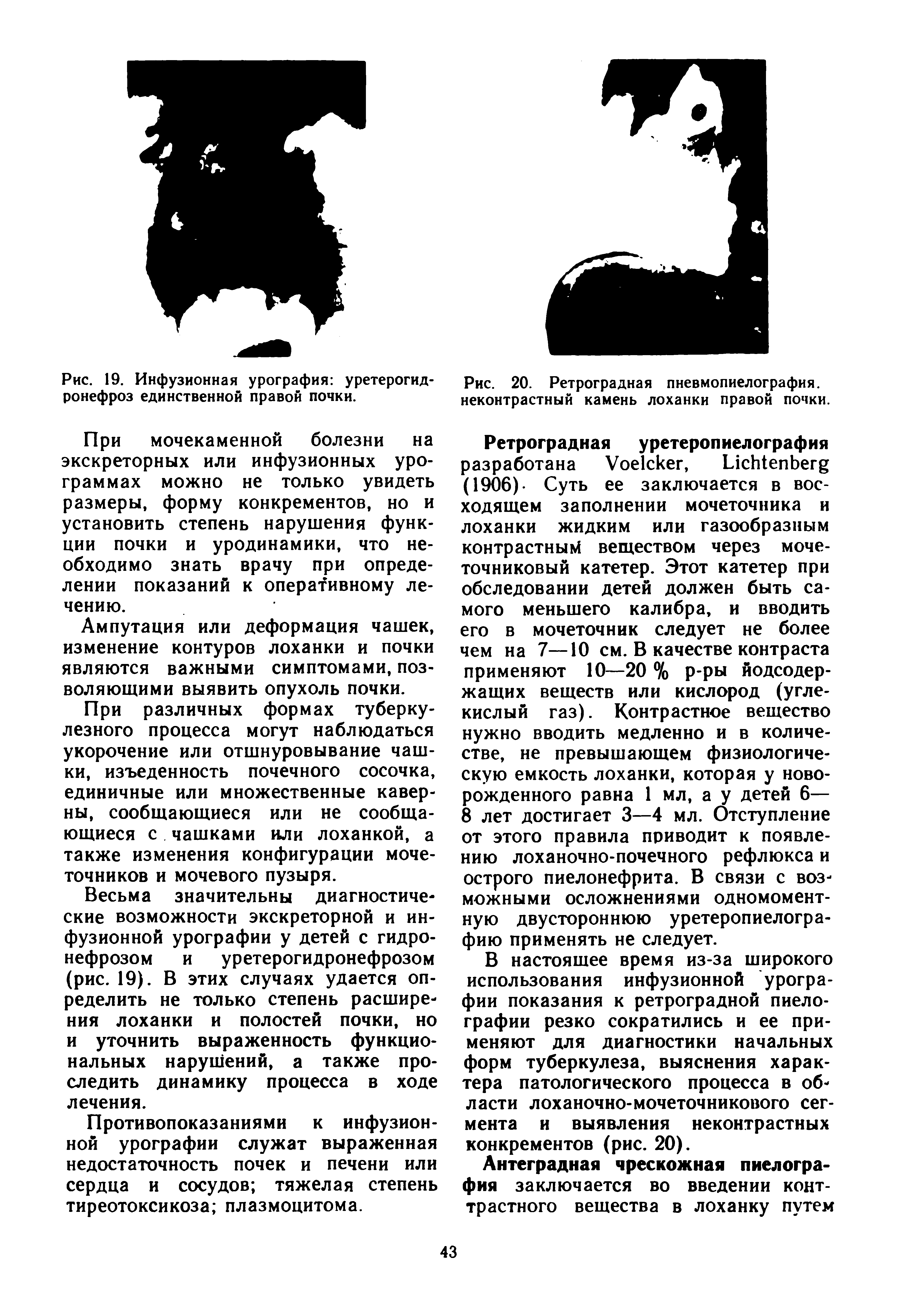 Рис. 20. Ретроградная пневмопиелография, неконтрастный камень лоханки правой почки.