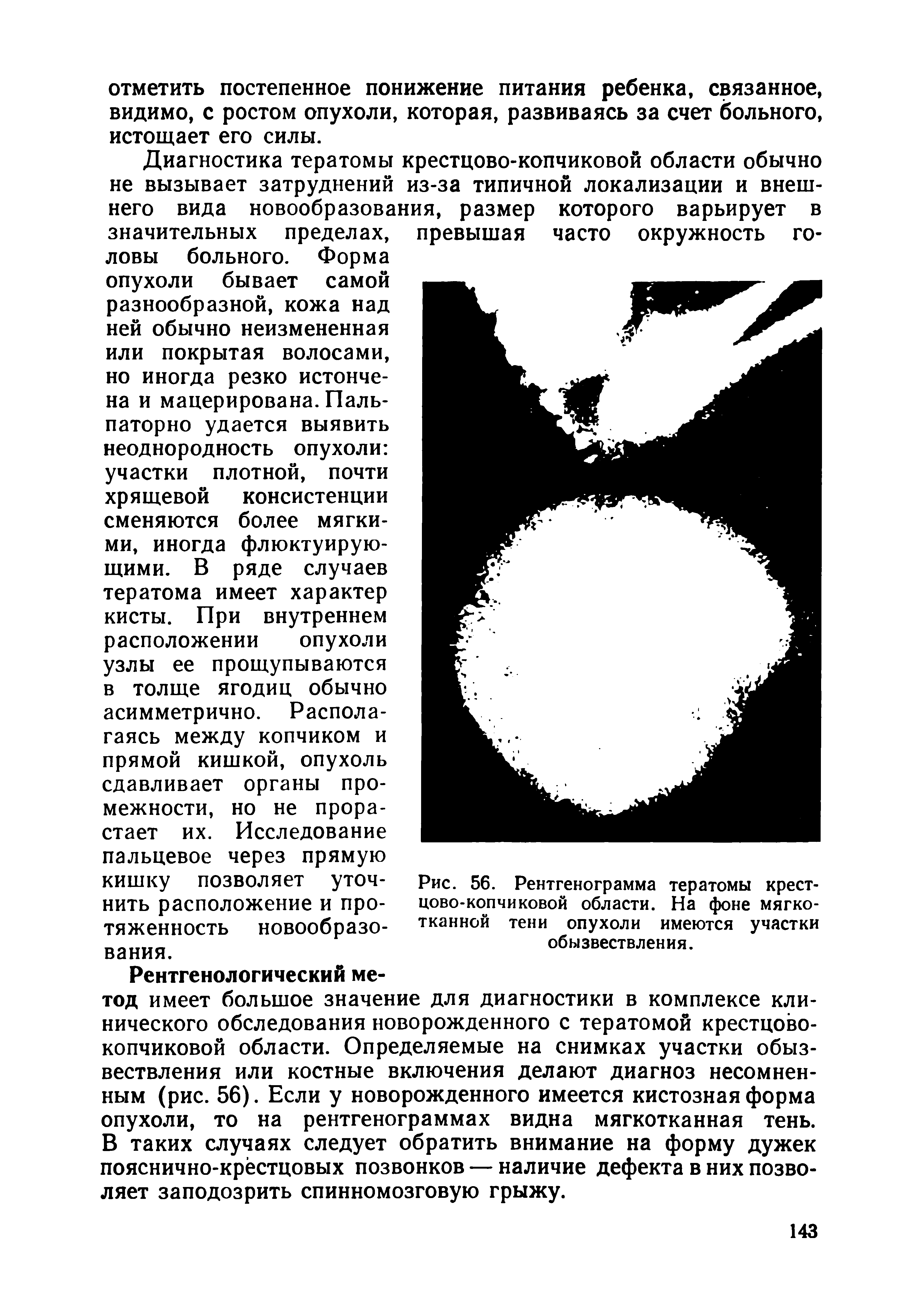 Рис. 56. Рентгенограмма тератомы крестцово-копчиковой области. На фоне мягкотканной тени опухоли имеются участки обызвествления.