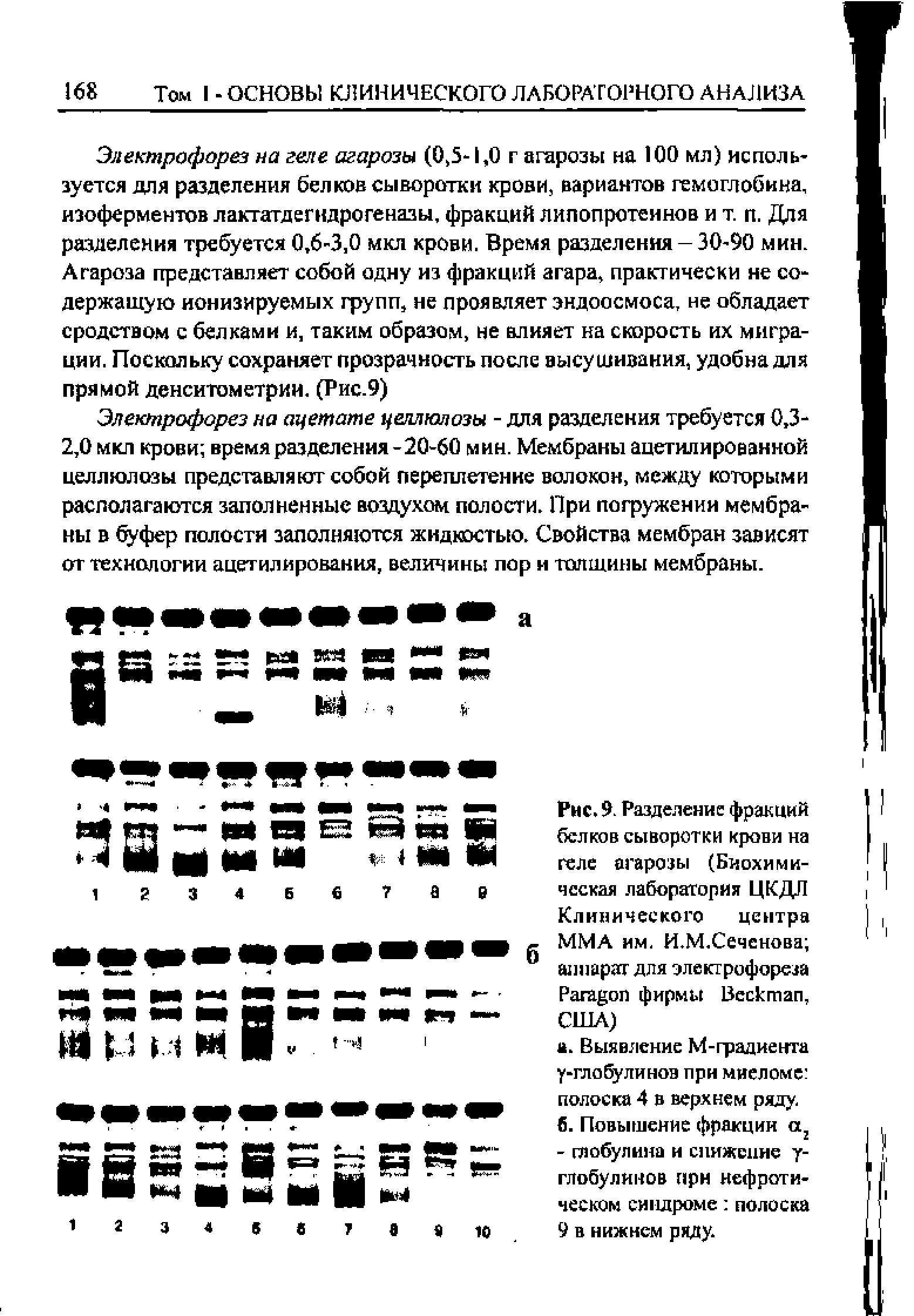 Рис. 9. Разделение фракций белков сыворотки крови на геле агарозы (Биохими-чсская лаборатория ЦКДЛ Клинического центра ММА им. И.М.Сеченова аппарат для электрофореза P фирмы B , США)...