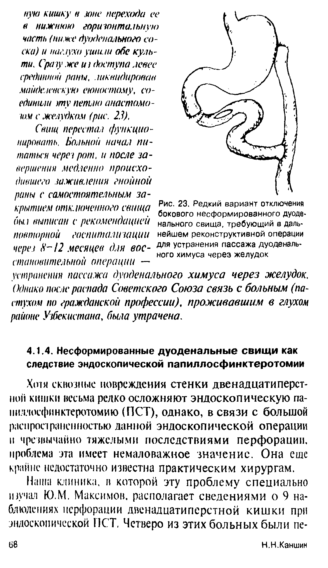 Рис. 23. Редкий вариант отключения бокового несформированного дуоденального свища, требующий в даль нейшем реконструктивной операции для устранения пассажа дуоденального химуса через желудок...