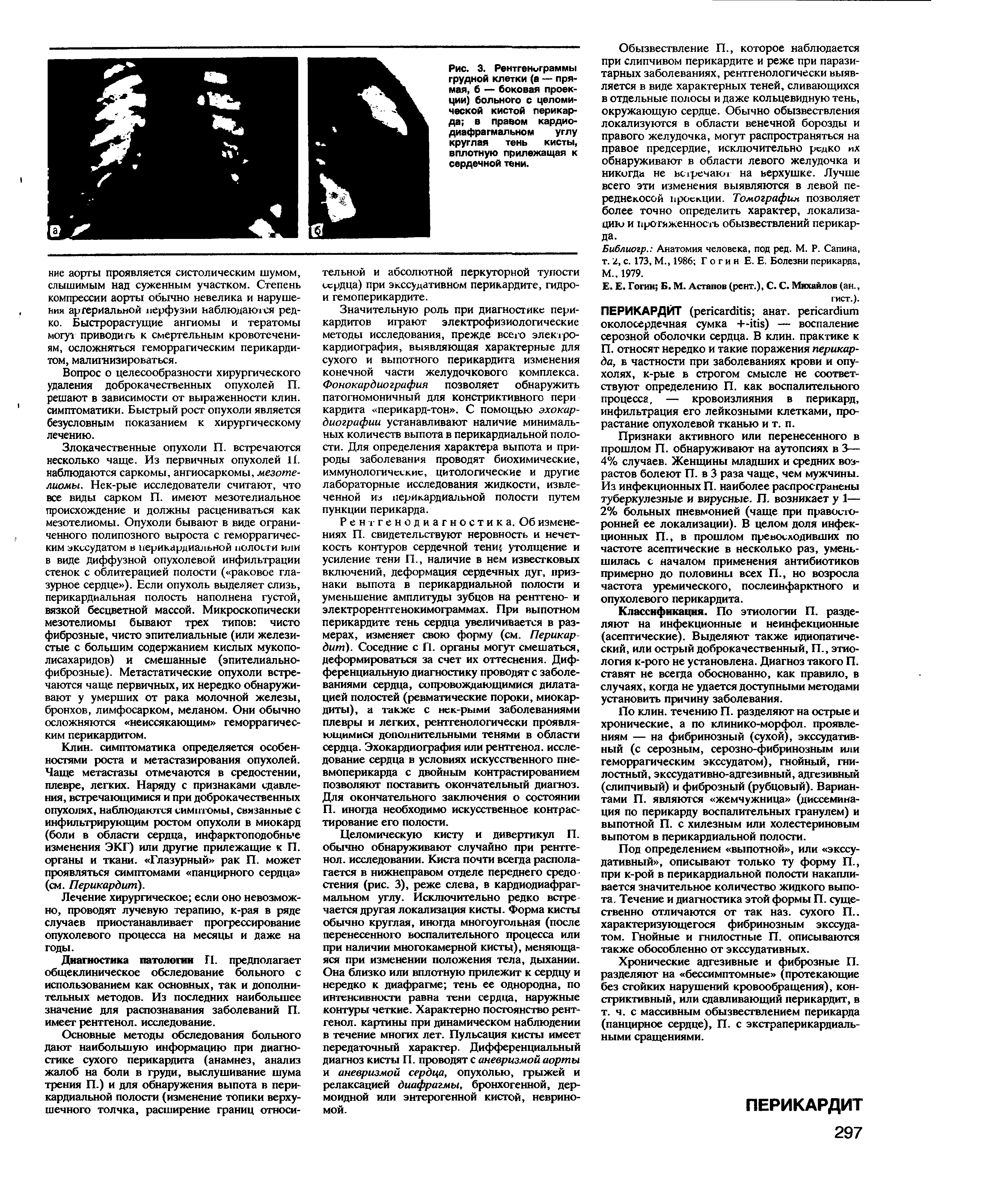 Рис. 3. Рентгениграммы грудной клетки (а — прямая, б — боковая проекции) больного с целомической кистой перикарда в правом кардио-диафрагмальном углу круглая тень кисты, вплотную прилежащая к сердечной тени.