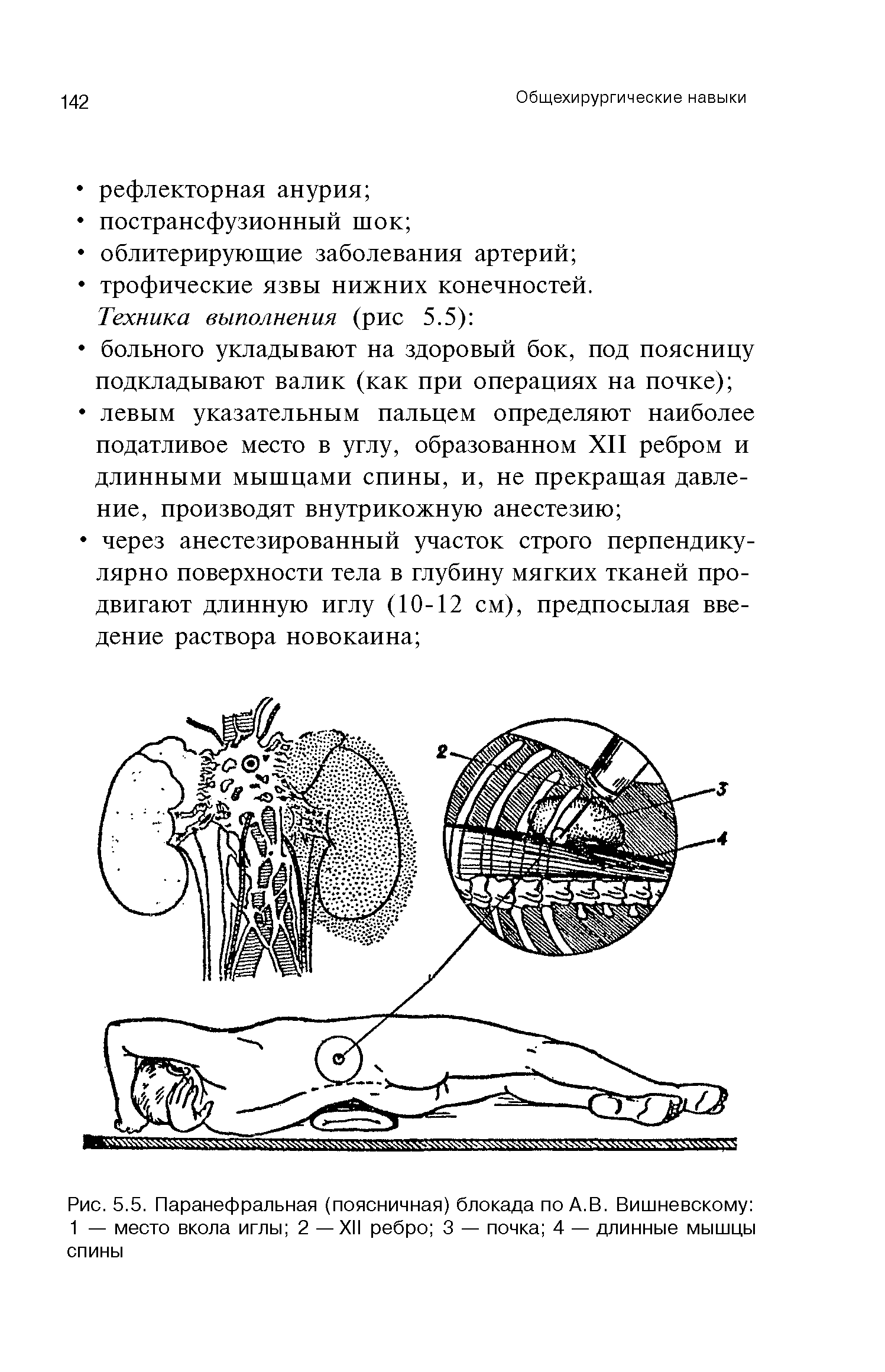 Рис. 5.5. Паранефральная (поясничная) блокада по А.В. Вишневскому 1 — место вкола иглы 2 —XII ребро 3 — почка 4 — длинные мышцы спины...