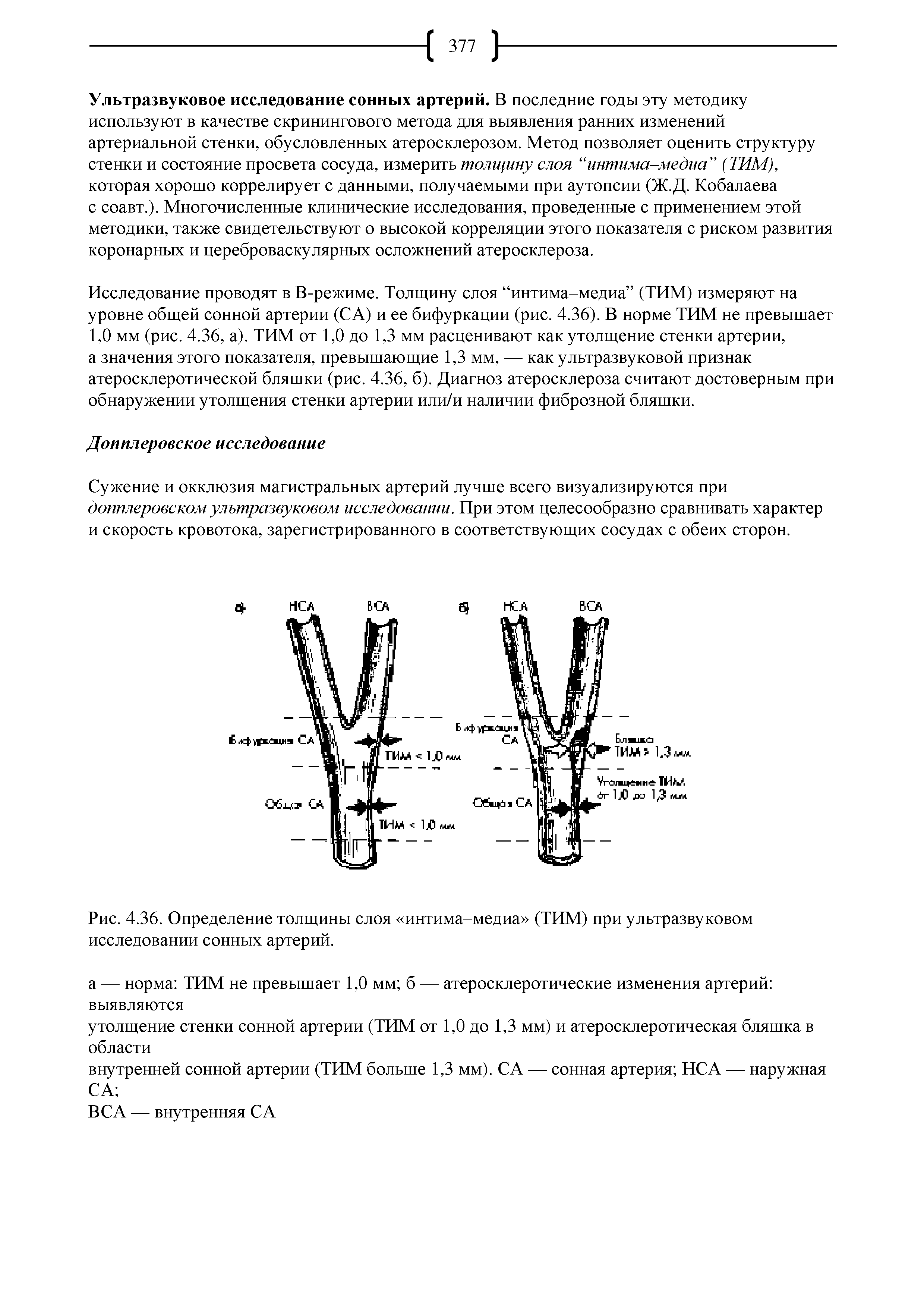 Рис. 4.36. Определение толщины слоя интима-медиа (ТИМ) при ультразвуковом исследовании сонных артерий.