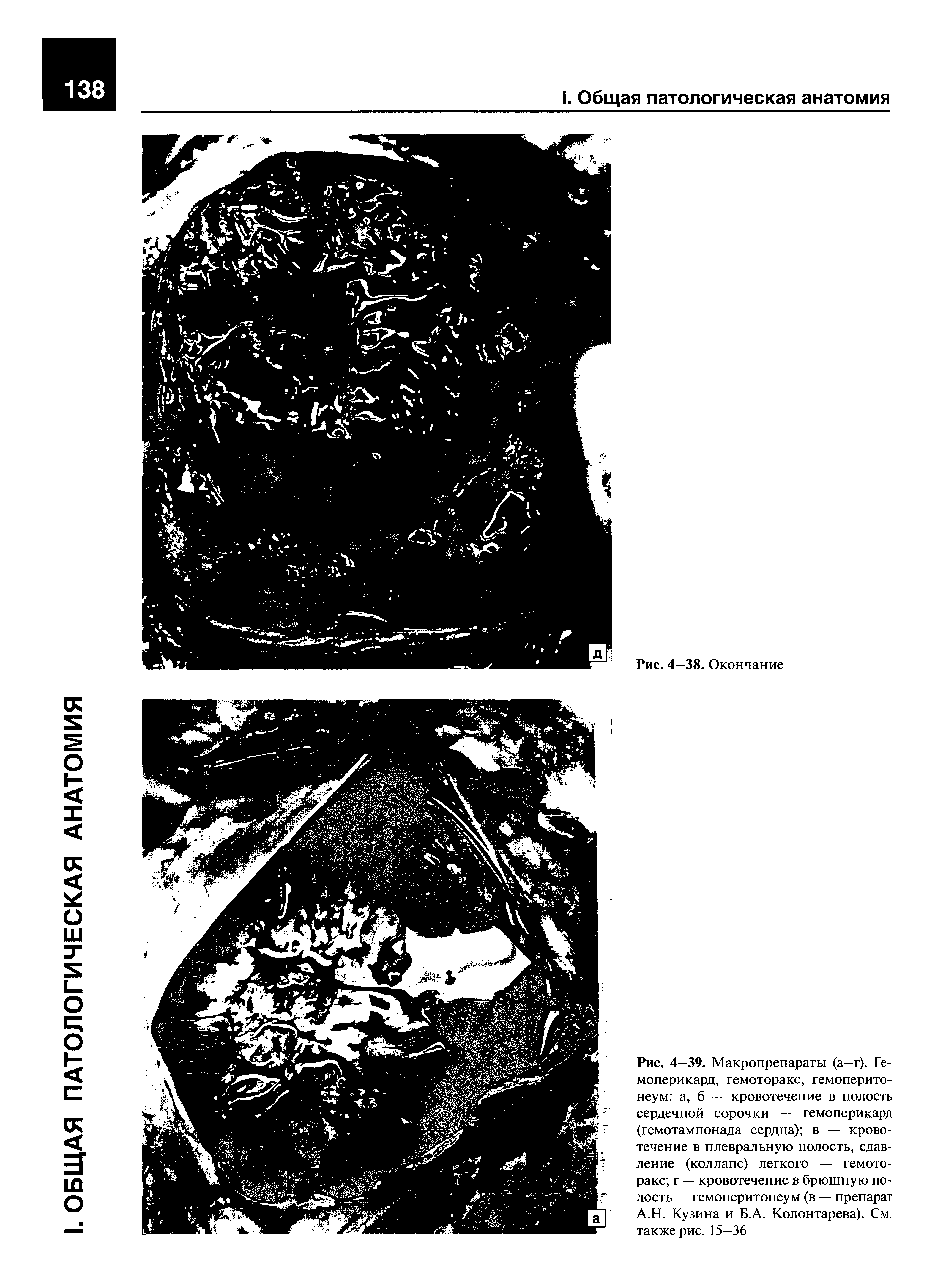 Рис. 4—39. Макропрепараты (а—г). Гемоперикард, гемоторакс, гемоперито-неум а, б — кровотечение в полость сердечной сорочки — гемоперикард (гемотампонада сердца) в — кровотечение в плевральную полость, сдавление (коллапс) легкого — гемоторакс г — кровотечение в брюшную полость — гемоперитонеум (в — препарат А.Н. Кузина и Б.А. Колонтарева). См. также рис. 15—36...