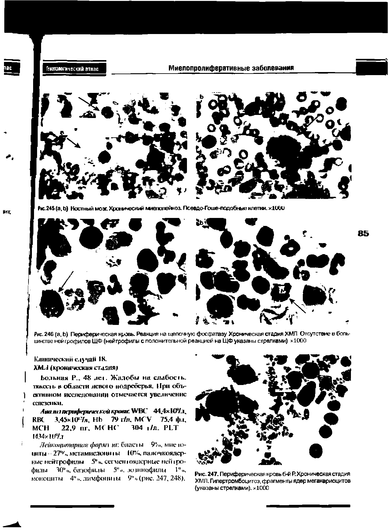 Рис. 247. Периферическая кровь б-й Р. Хроническая стадия ХМЛ. Гипертромбоцитоз, фрагменты ядер мегакариоцитов (указаны стрелками). >1000...