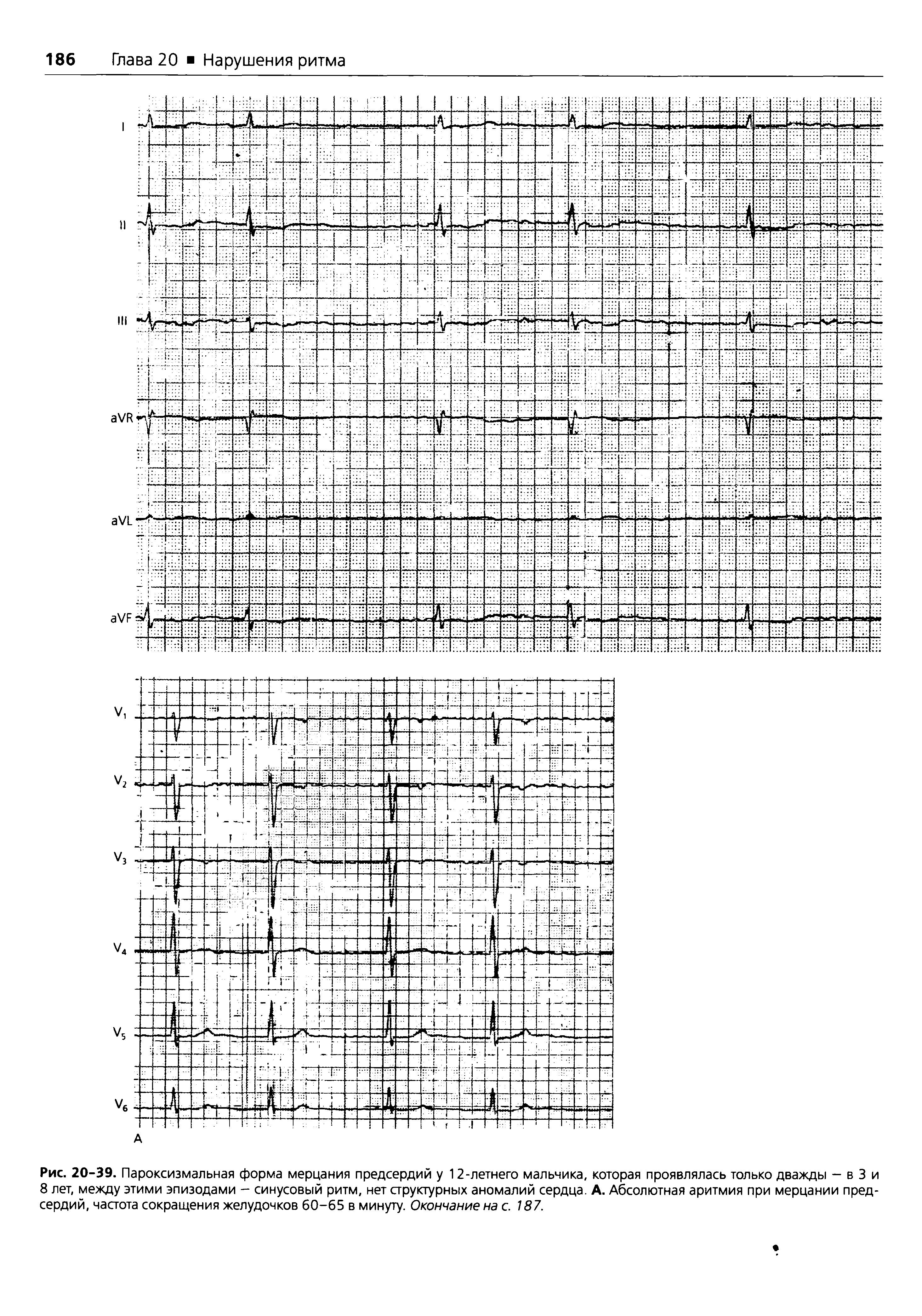 Рис. 20-39. Пароксизмальная форма мерцания предсердий у 12-летнего мальчика, которая проявлялась только дважды - в 3 и 8 лет, между этими эпизодами - синусовый ритм, нет структурных аномалий сердца. А. Абсолютная аритмия при мерцании предсердий, частота сокращения желудочков 60-65 в минуту. Окончание на с. 187.