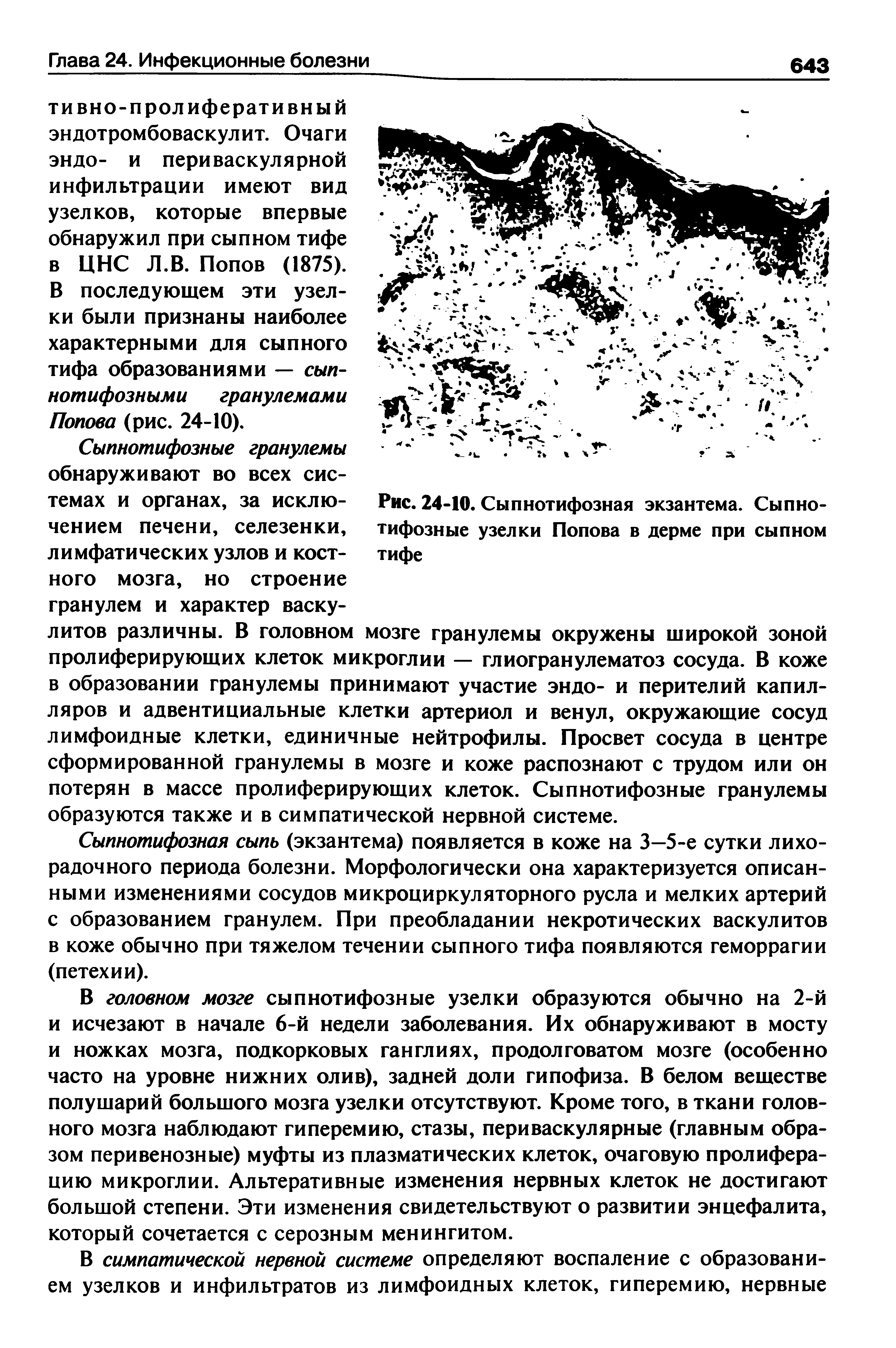 Рис. 24-10. Сыпнотифозная экзантема. Сыпнотифозные узелки Попова в дерме при сыпном тифе...