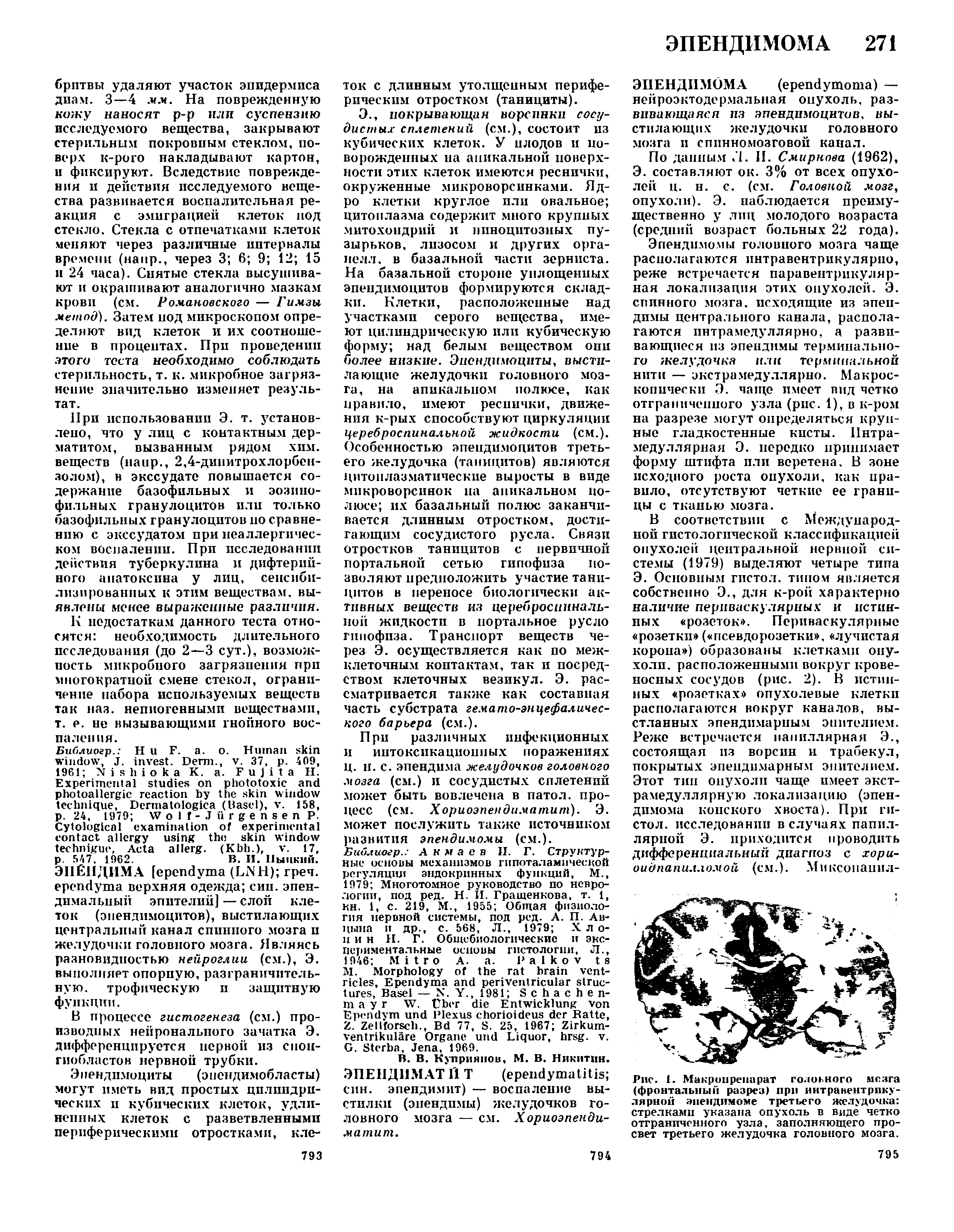 Рис. 1. Макропрепарат головного мезга (фронтальный разрез) при интравентрикулярной эпендимоме третьего желудочка стрелками указана опухоль в виде четко отграниченного узла, заполняющего просвет третьего желудочка головного мозга.