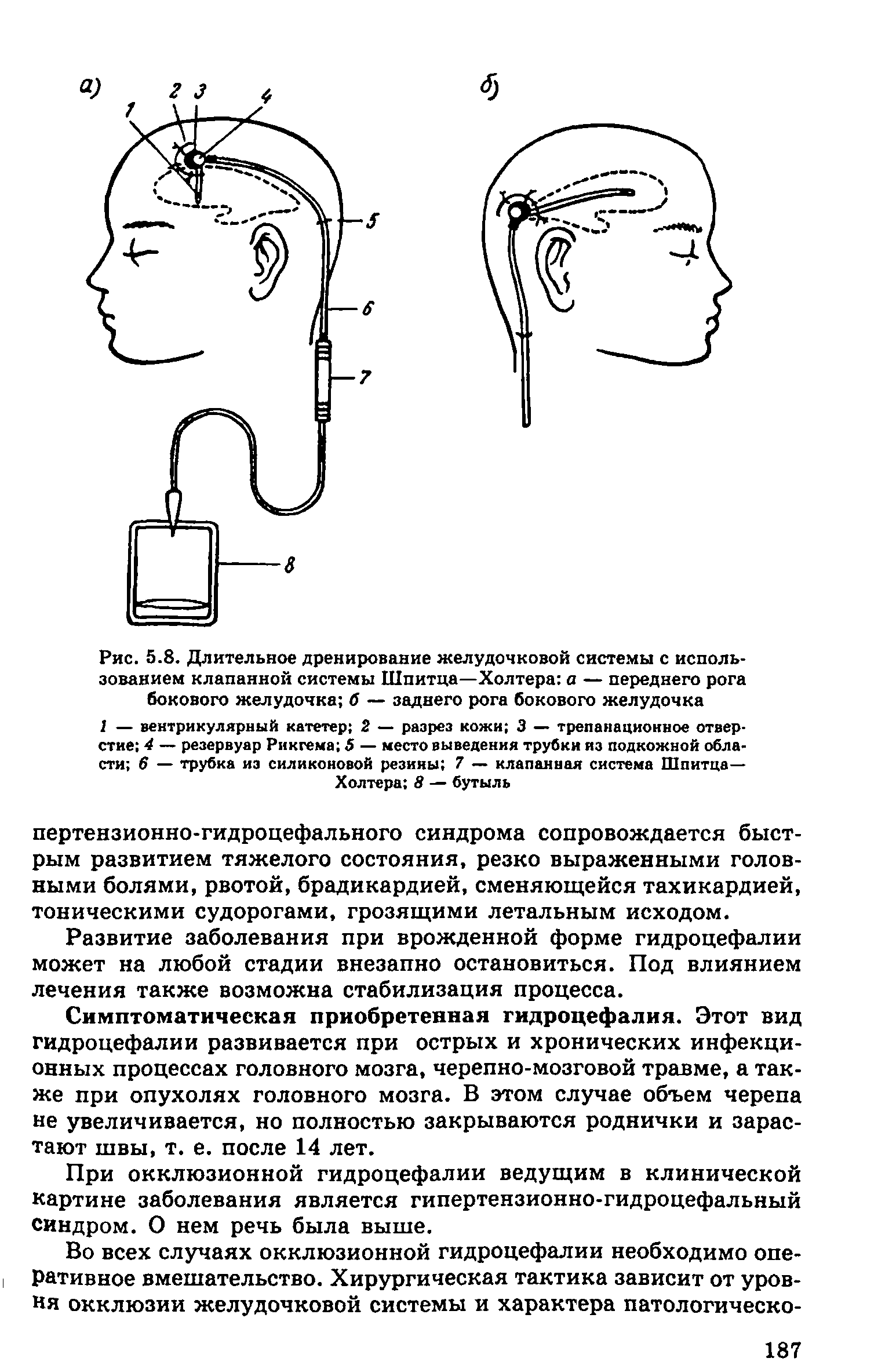 Рис. 5.8. Длительное дренирование желудочковой системы с использованием клапанной системы Шпитца—Холтера а — переднего рога бокового желудочка б — заднего рога бокового желудочка...