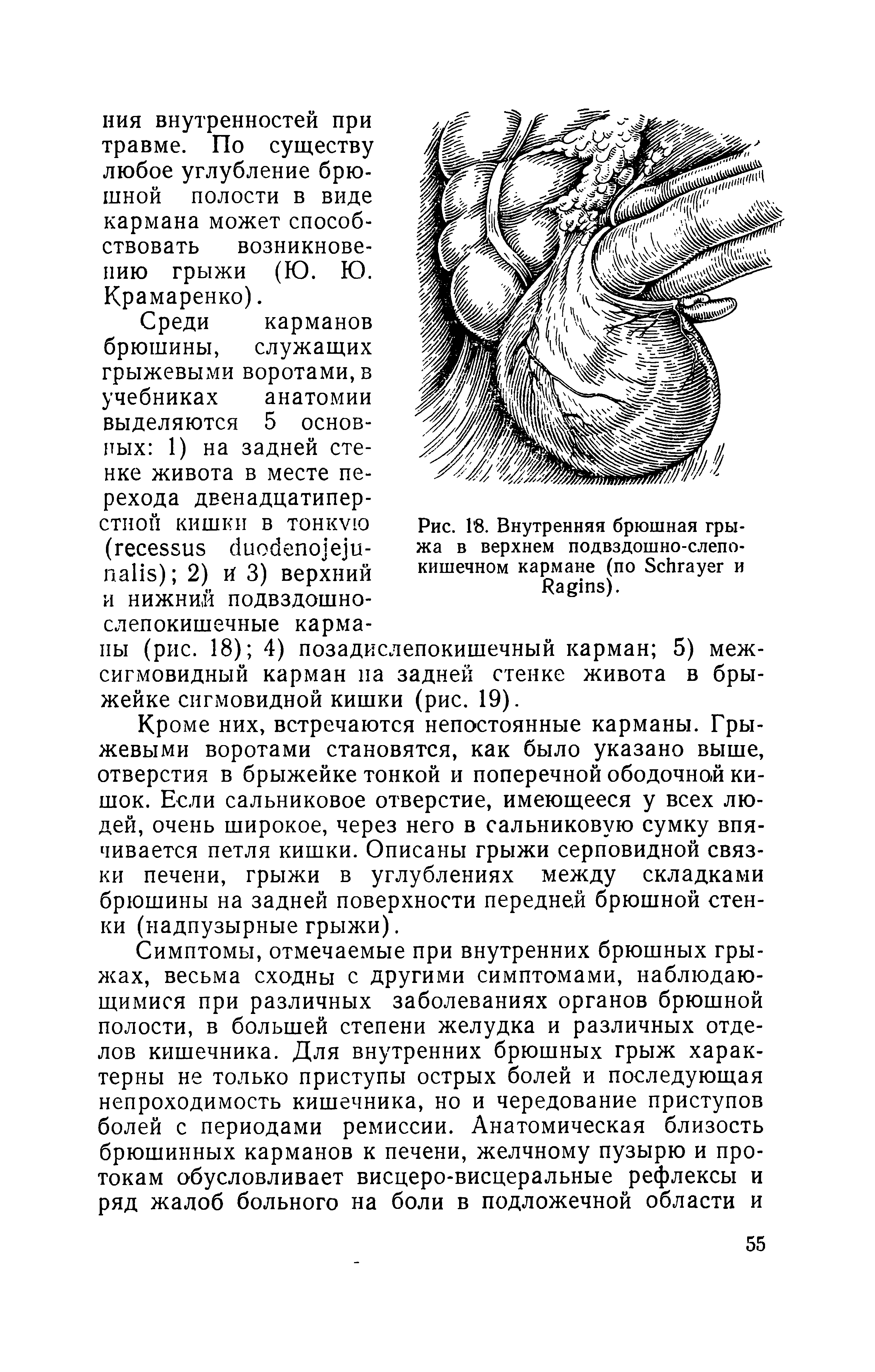 Рис. Г8. Внутренняя брюшная грыжа в верхнем подвздошно-слепокишечном кармане (по ЗсЬгауег и...