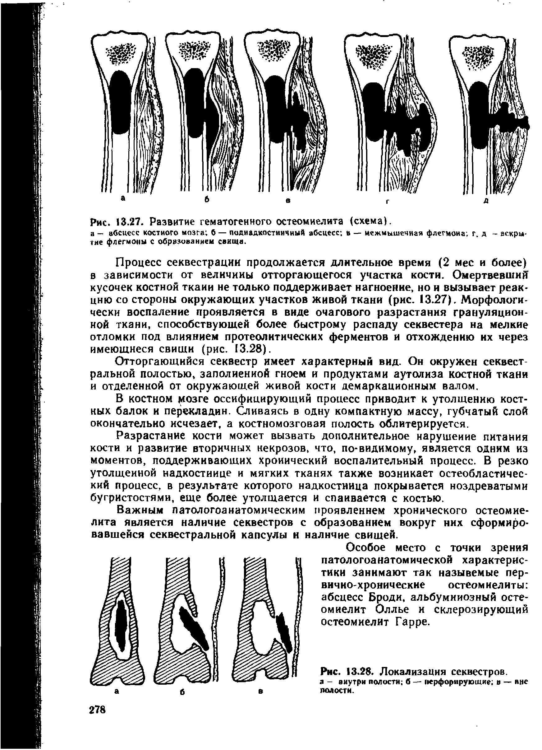 Рис. 13.27. Развитие гематогенного остеомиелита (схема), а — абсцесс костного мозга б — поднадкостничный абсцесс а — межмышечная флегмона, г, д - закрытие флегмоны с образованием свища.