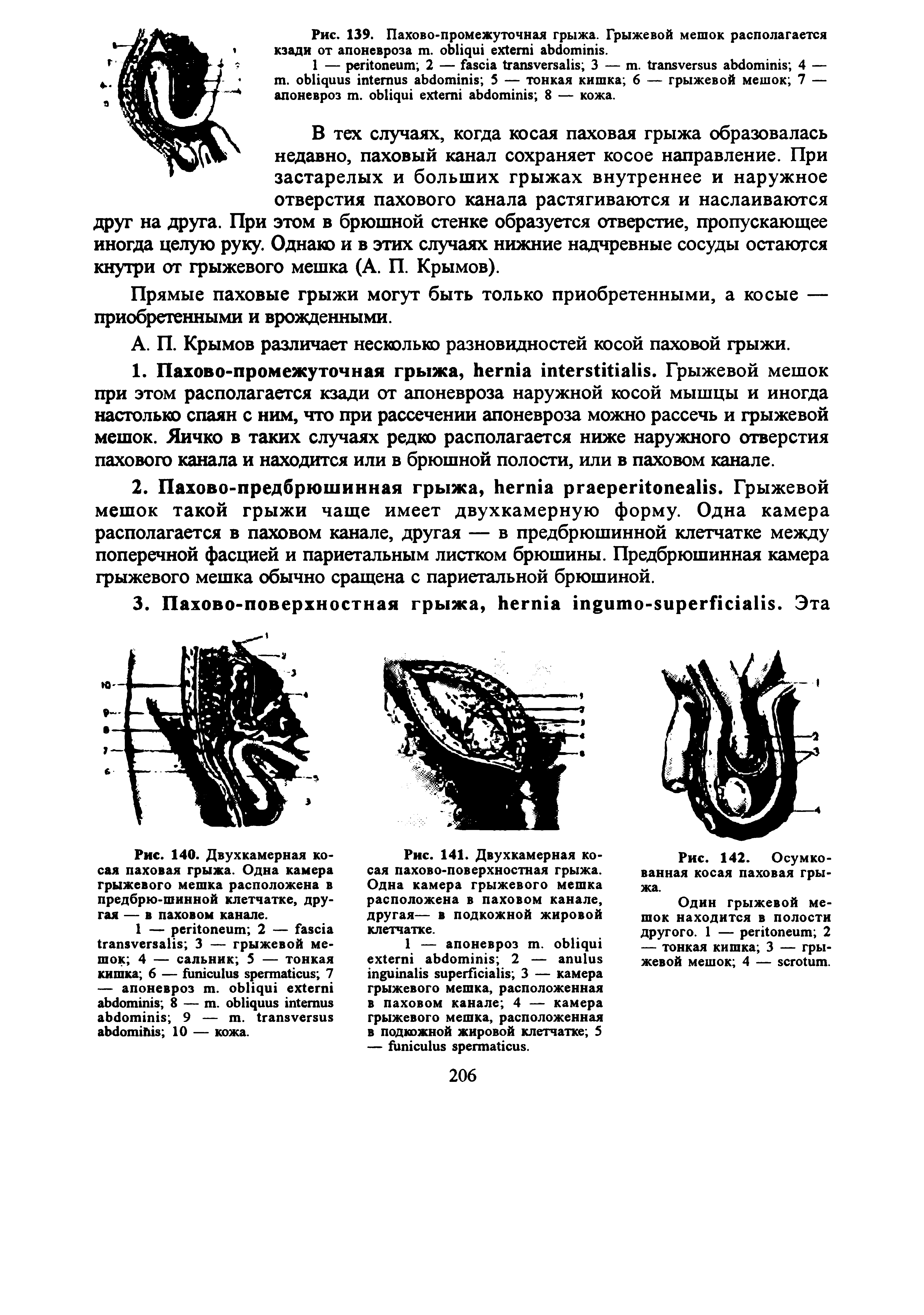 Рис. 141. Двухкамерная косая пахово-поверхностная грыжа. Одна камера грыжевого мешка расположена в паховом канале, другая— в подкожной жировой клетчатке.