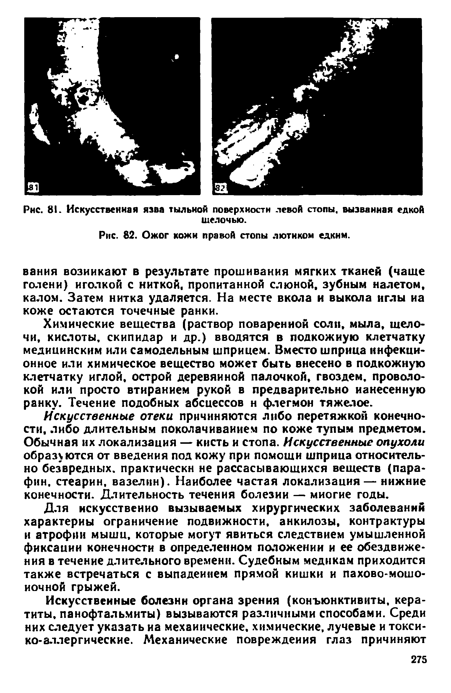 Рис. 82. Ожог кожи правой стопы лютиком едким.