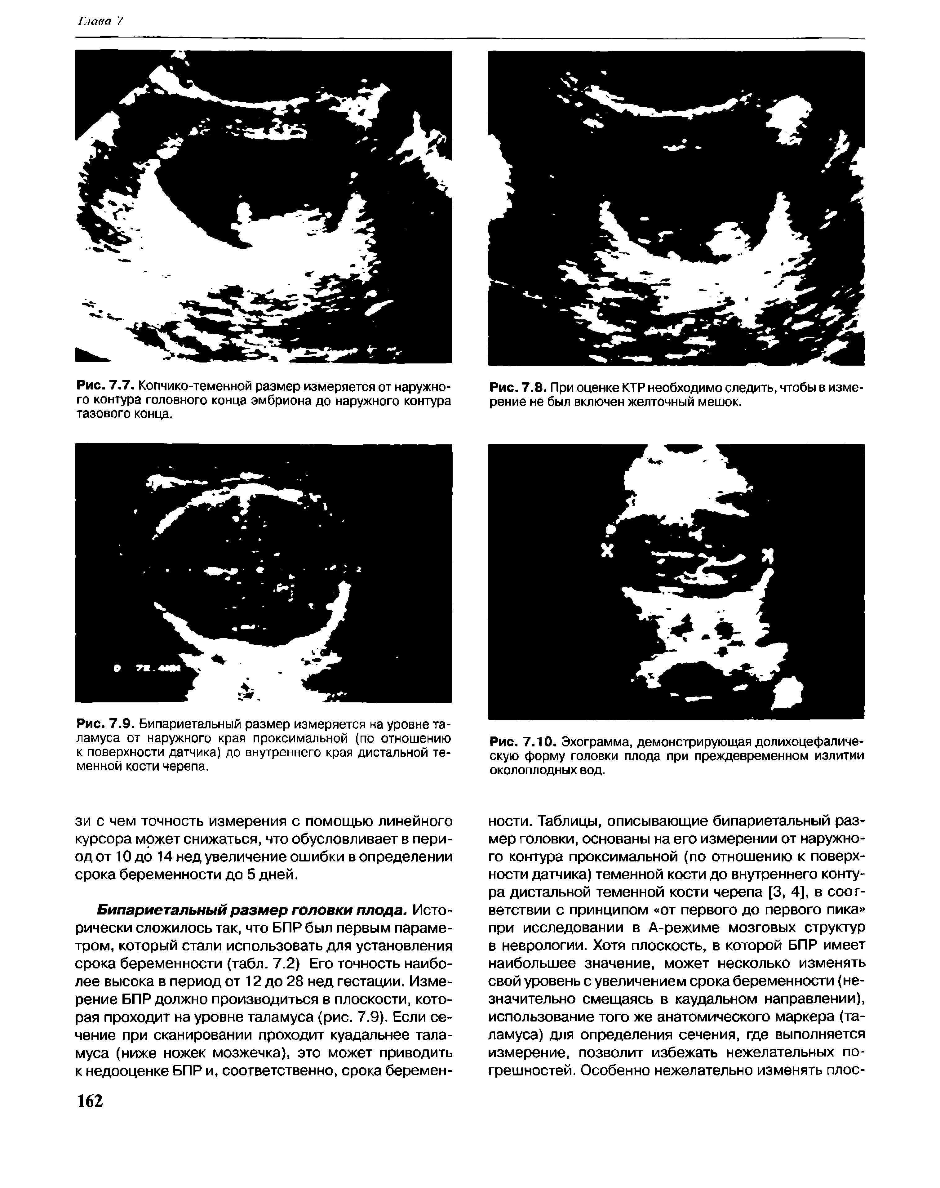 Рис. 7.10. Эхограмма, демонстрирующая долихоцефаличе-скую форму головки плода при преждевременном излитии околоплодных вод.