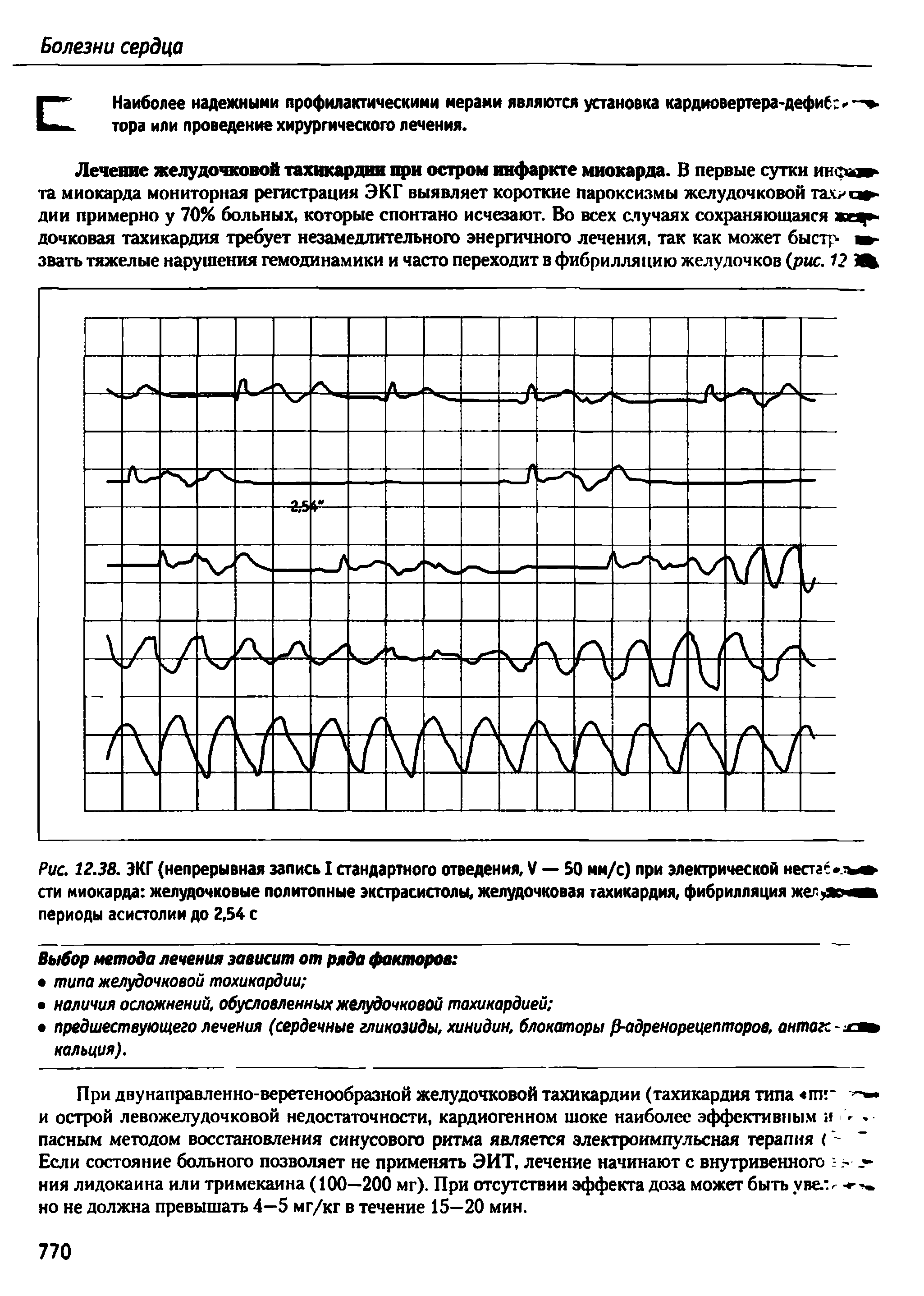 Рис. 12.38. ЭКГ (непрерывная запись I стандартного отведения, V — 50 мм/с) при электрической нестас /ь сти миокарда желудочковые политопные экстрасистолы, желудочковая тахикардия, фибрилляция периоды асистолии до 2,54 с...