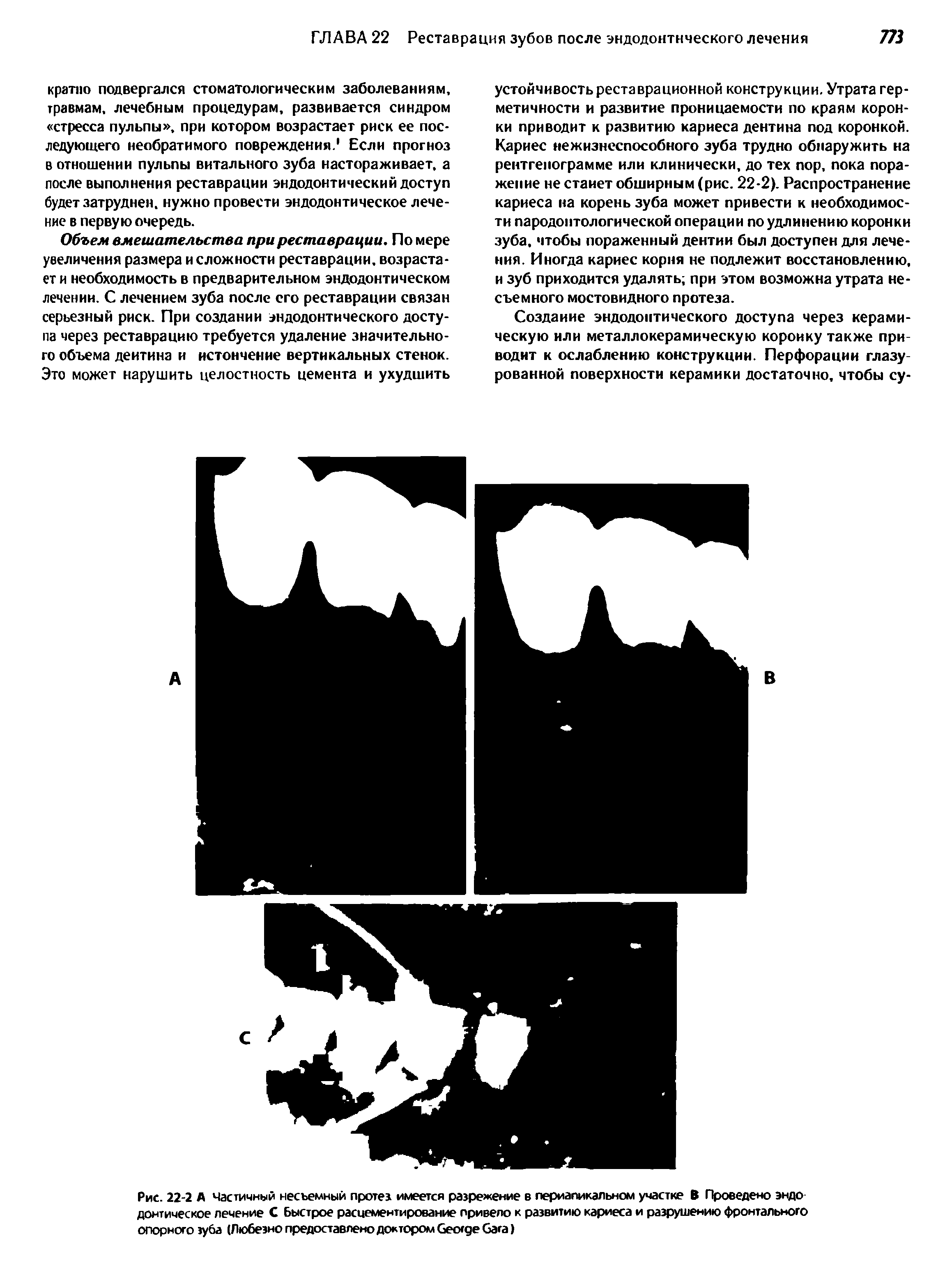 Рис. 22-2 А Частичный несъемный протез имеется разрежение в периапикальном участке В Проведено эндо донтическое лечение С Быстрое расиементирование привело к развитию кариеса и разрушению фронтального опорного зуба (Любезно предоставлено доктором G G )...