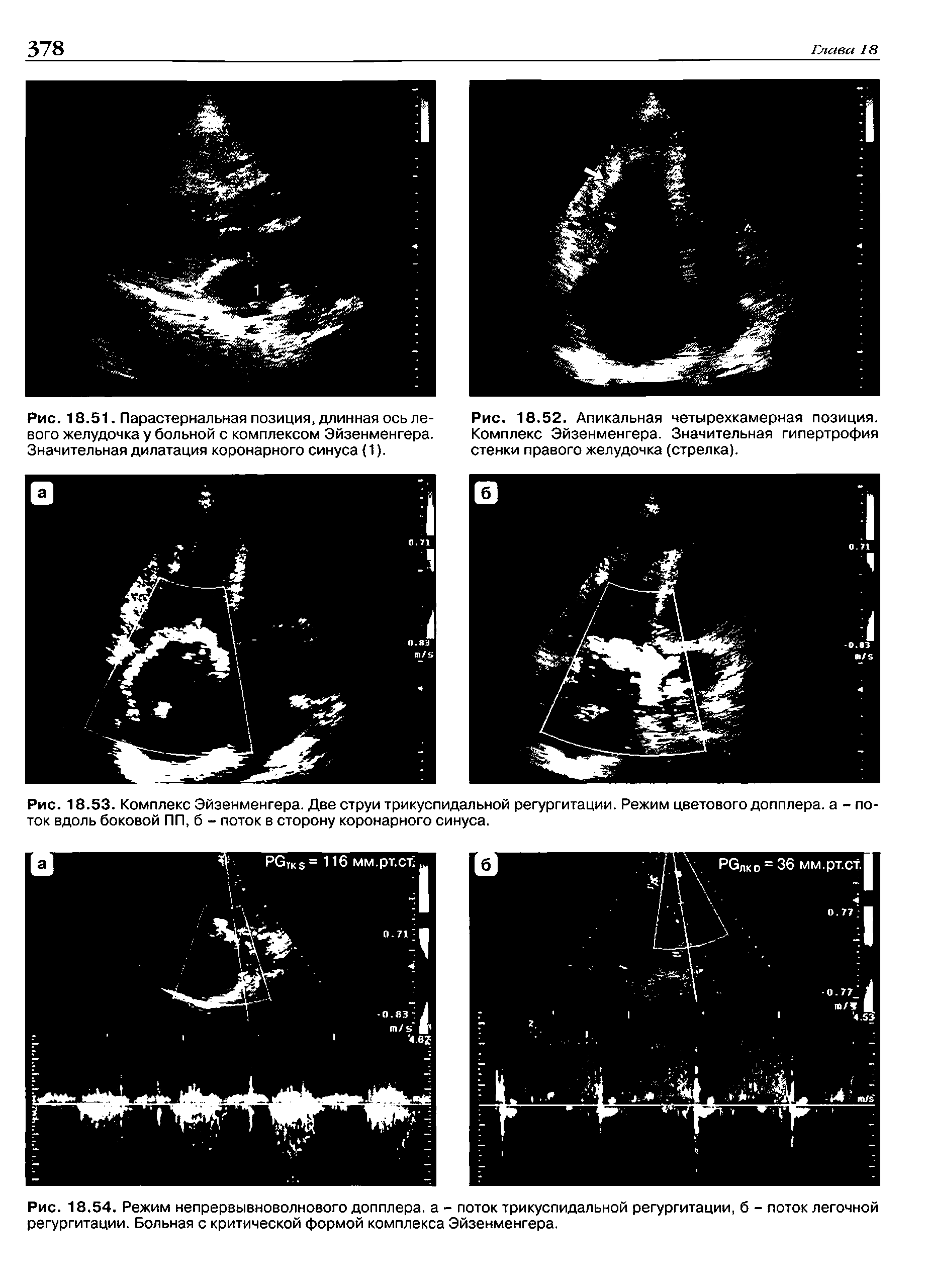 Рис. 18.53. Комплекс Эйзенменгера. Две струи трикуспидальной регургитации. Режим цветового допплера, а - лоток вдоль боковой ПП, б - поток в сторону коронарного синуса.