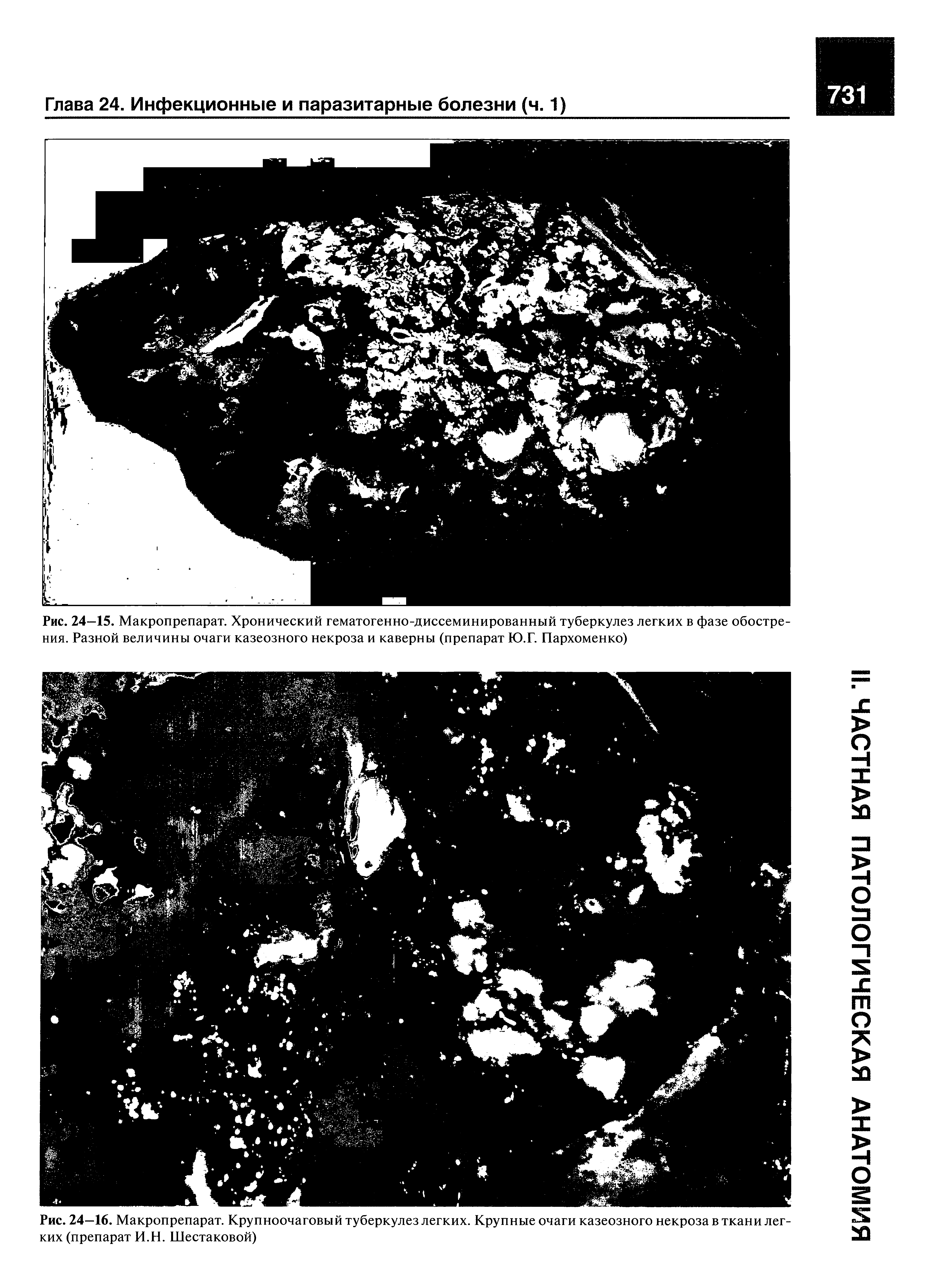 Рис. 24—15. Макропрепарат. Хронический гематогенно-диссеминированный туберкулез легких в фазе обострения. Разной величины очаги казеозного некроза и каверны (препарат Ю.Г. Пархоменко)...