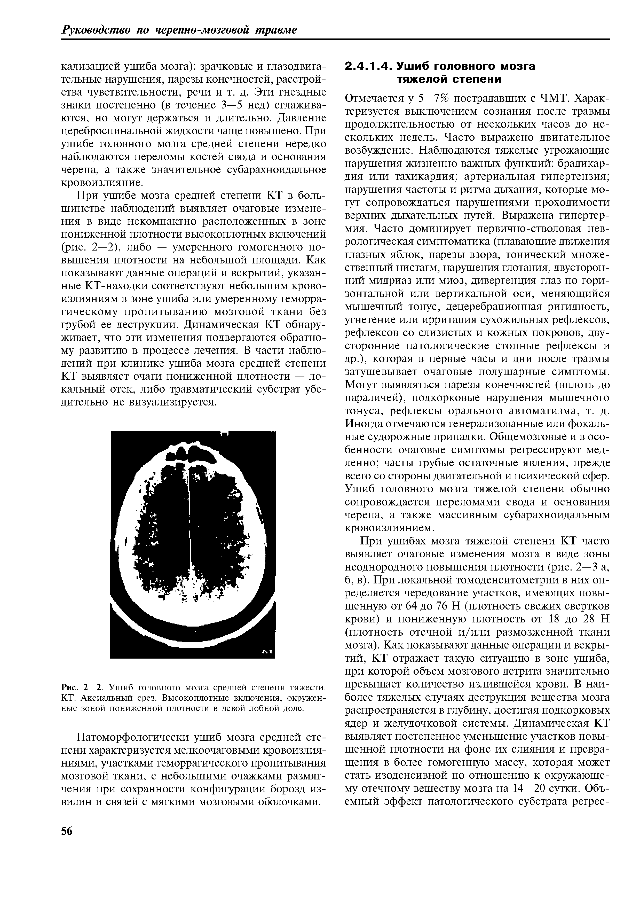 Рис. 2—2. Ушиб головного мозга средней степени тяжести. КТ. Аксиальный срез. Высокоплотные включения, окруженные зоной пониженной плотности в левой лобной доле.