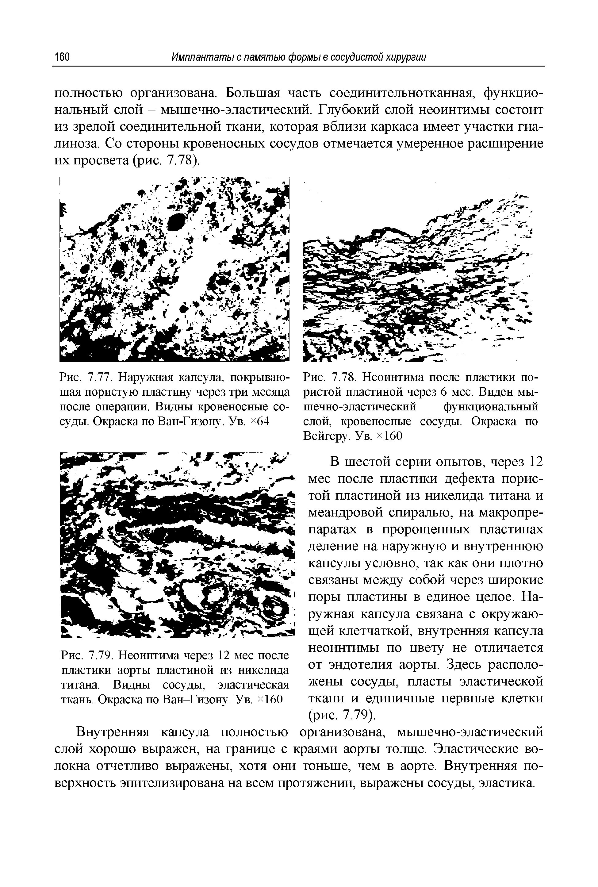 Рис. 7.79. Неоинтима через 12 мес после пластики аорты пластиной из никелида титана. Видны сосуды, эластическая ткань. Окраска по Ван-Гизону. Ув. 160...