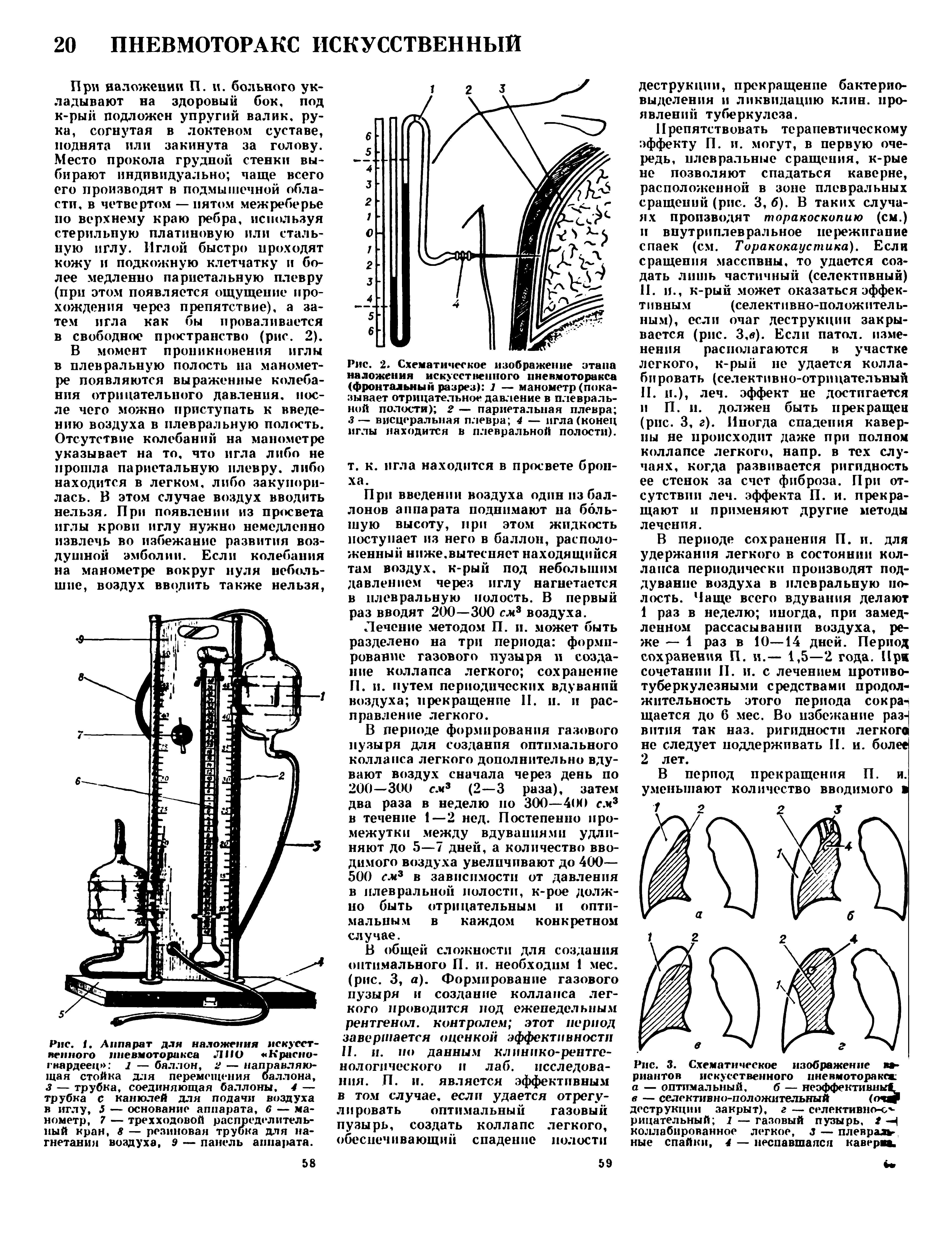 Рис. 3. Схематическое изображение вариантов искусственного пневмотораксе а — оптимальный, б — неэффективны в — селективно-положительный (оч деструкции закрыт), г — селективно-отрицательный 1 — газовый пузырь, 2 -И коллабированное легкое, з — плевральные спайки, 4 — неспавшаяся кавераа.