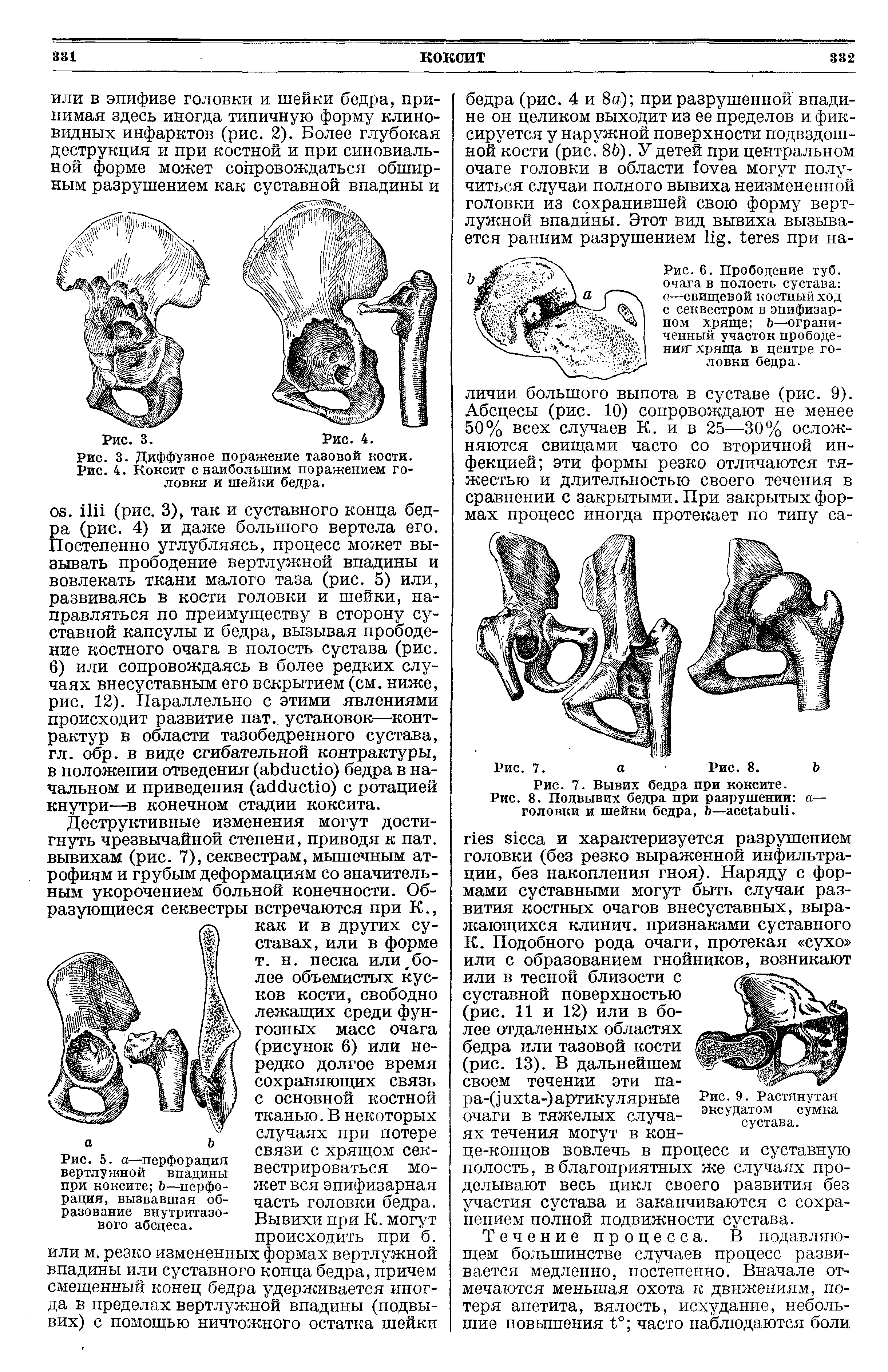 Рис. 8. Подвывих бедра при разрушении а— головки и шейки бедра, Ь—асе аЬиИ.