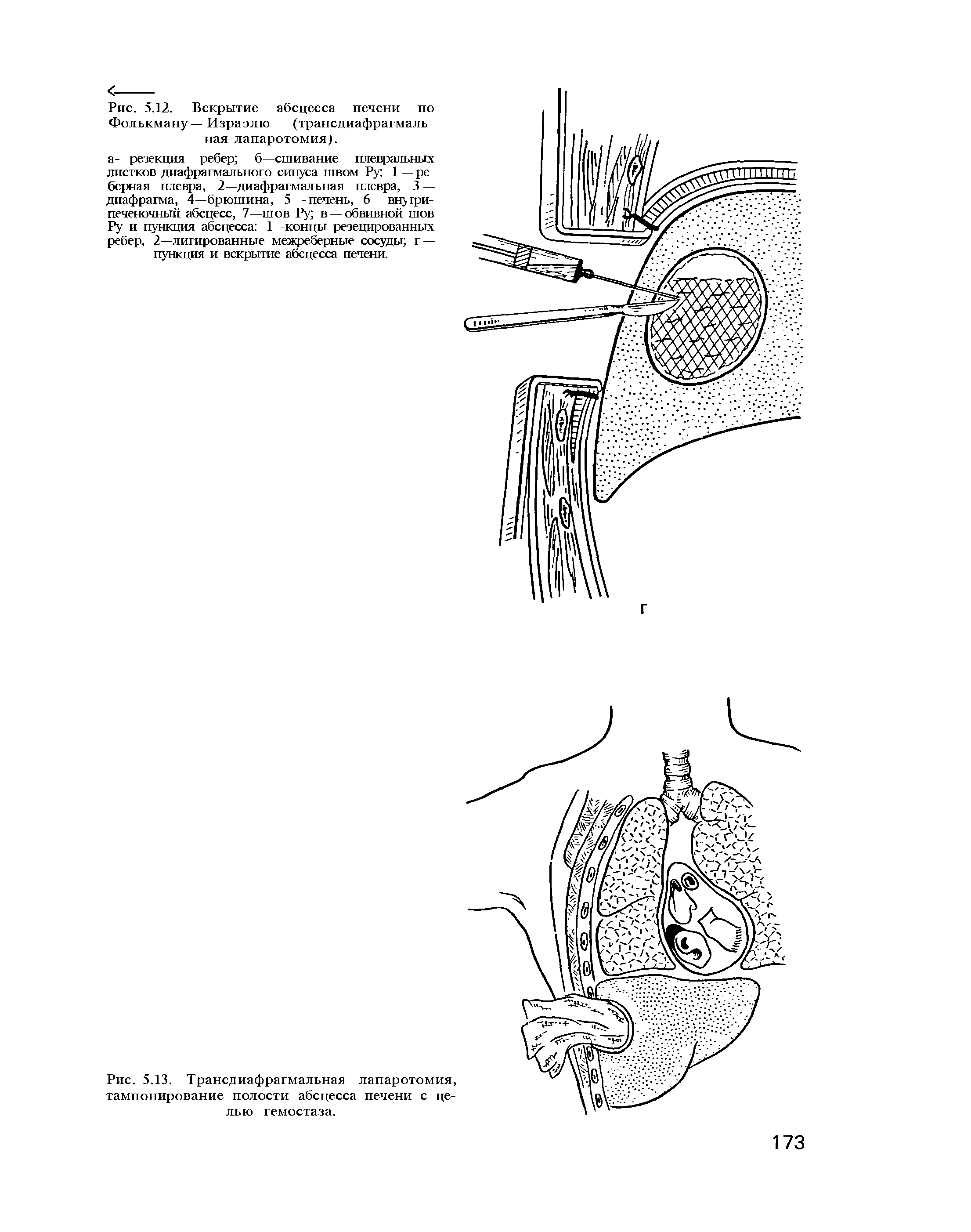Рис. 5.12. Вскрытие абсцесса печени по Фолькману — Израэлю (трансдиафрагмаль ная лапаротомия).