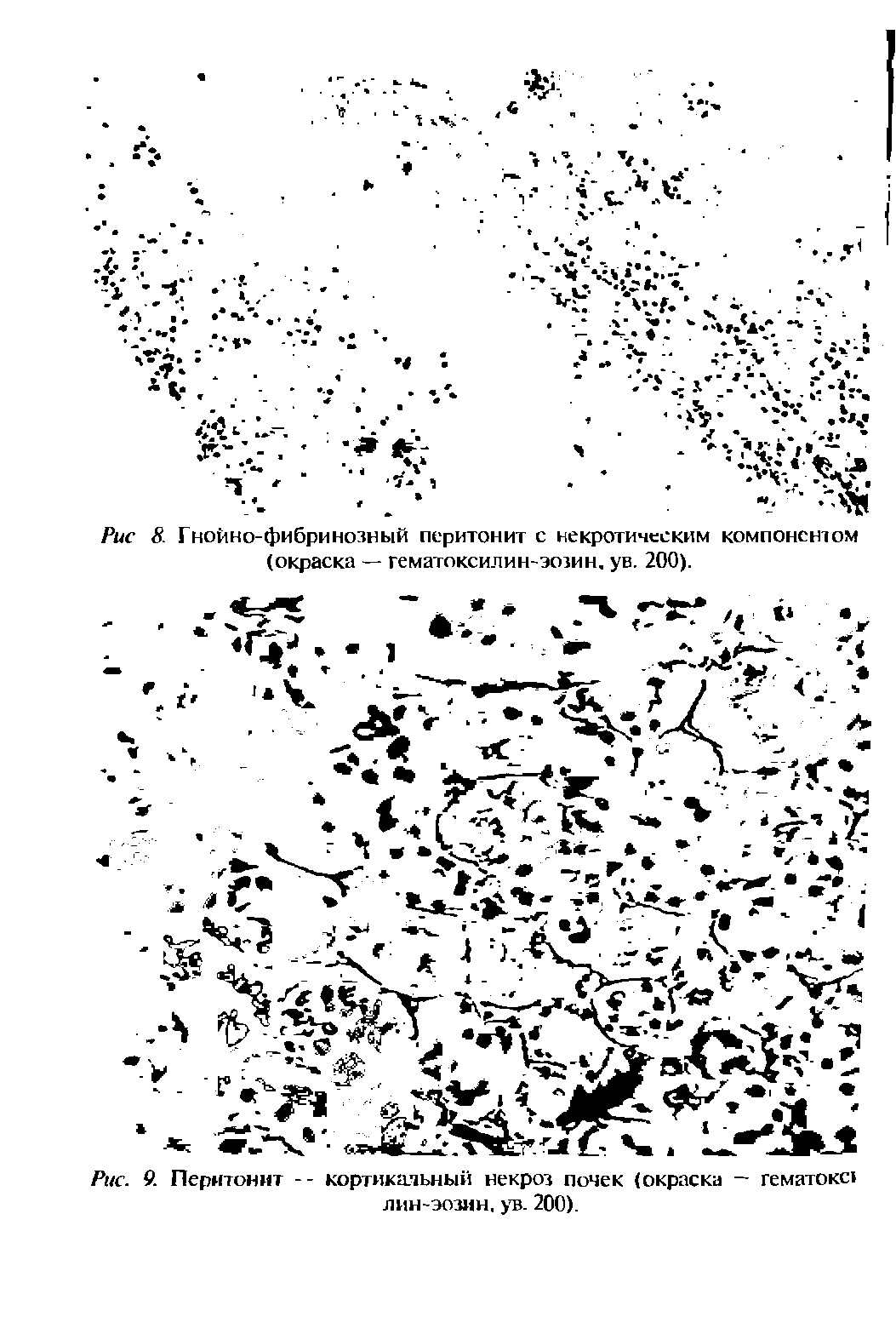 Рис. 9. Перитонит -- кортикальный некроз почек (окраска — гематокс лин-эозмн. ув. 200).