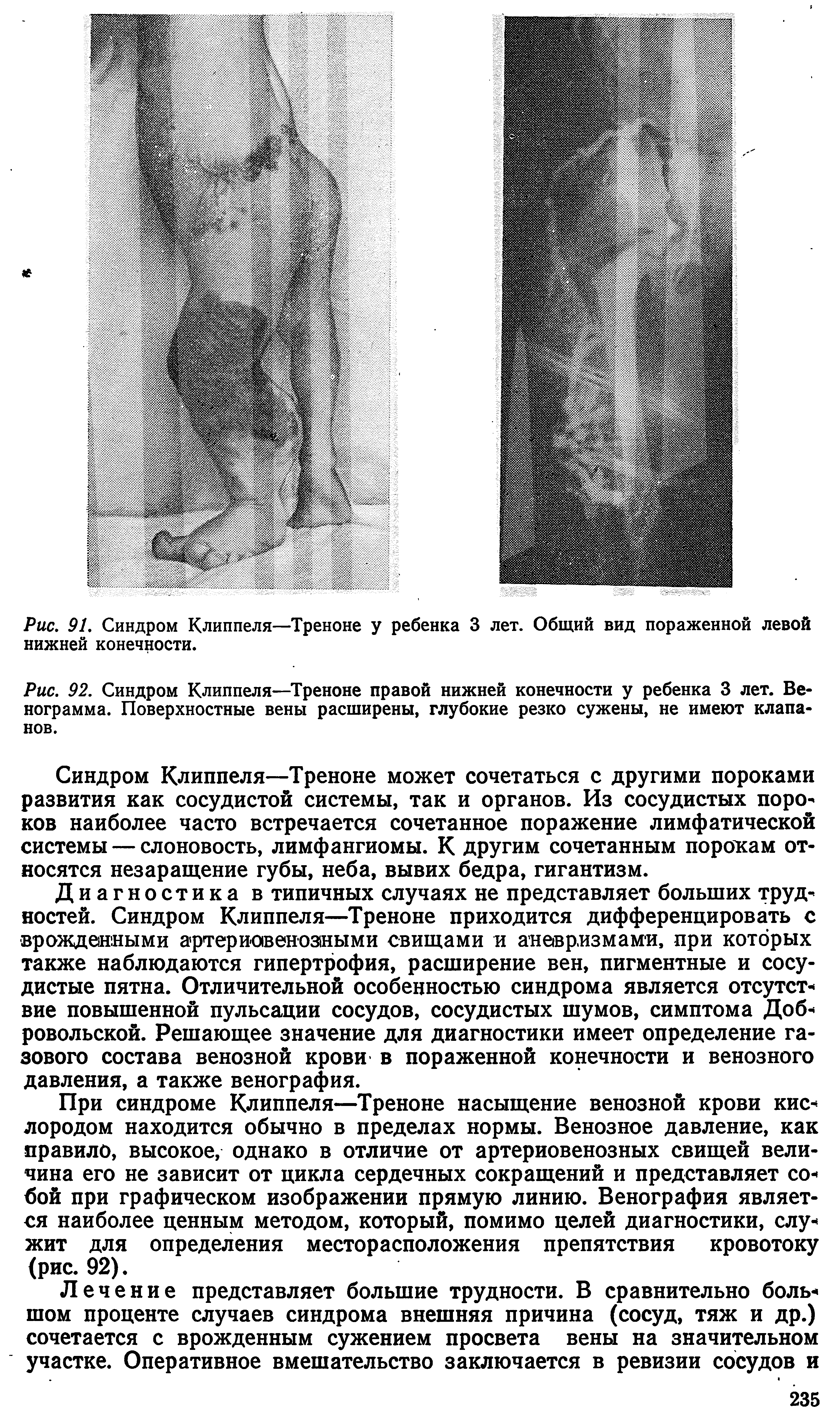 Рис. 92. Синдром Клиппеля—Треноне правой нижней конечности у ребенка 3 лет. Венограмма. Поверхностные вены расширены, глубокие резко сужены, не имеют клапанов.