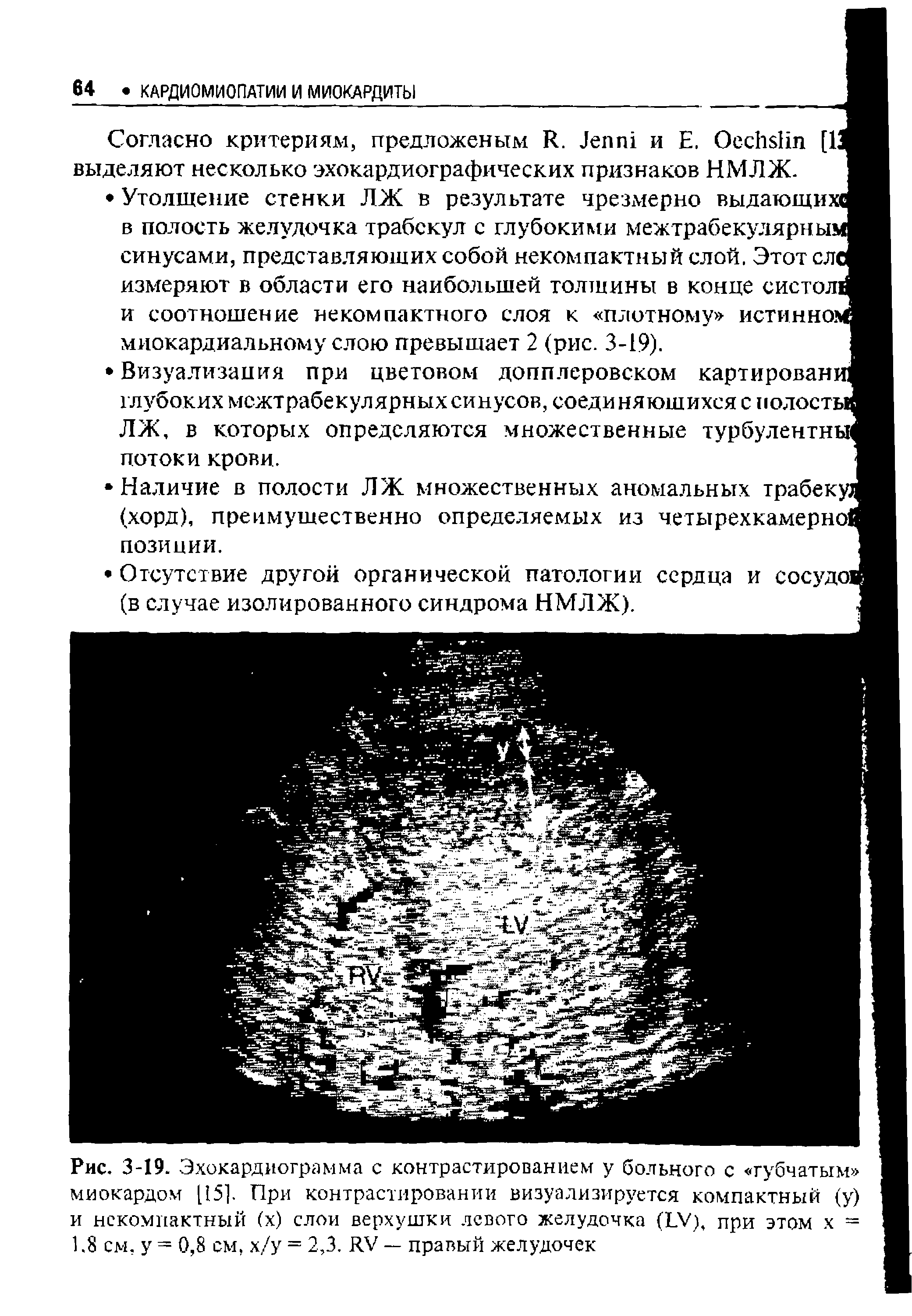 Рис. 3-19. Эхокардиограмма с контрастированием у больного с губчатым миокардом [15]. При контрастировании визуализируется компактный (у) и некомпактный (х) слои верхушки левого желудочка (LV), при этом х = 1.8 см, у = 0,8 см. х/у = 2,3. RV — правый желудочек...