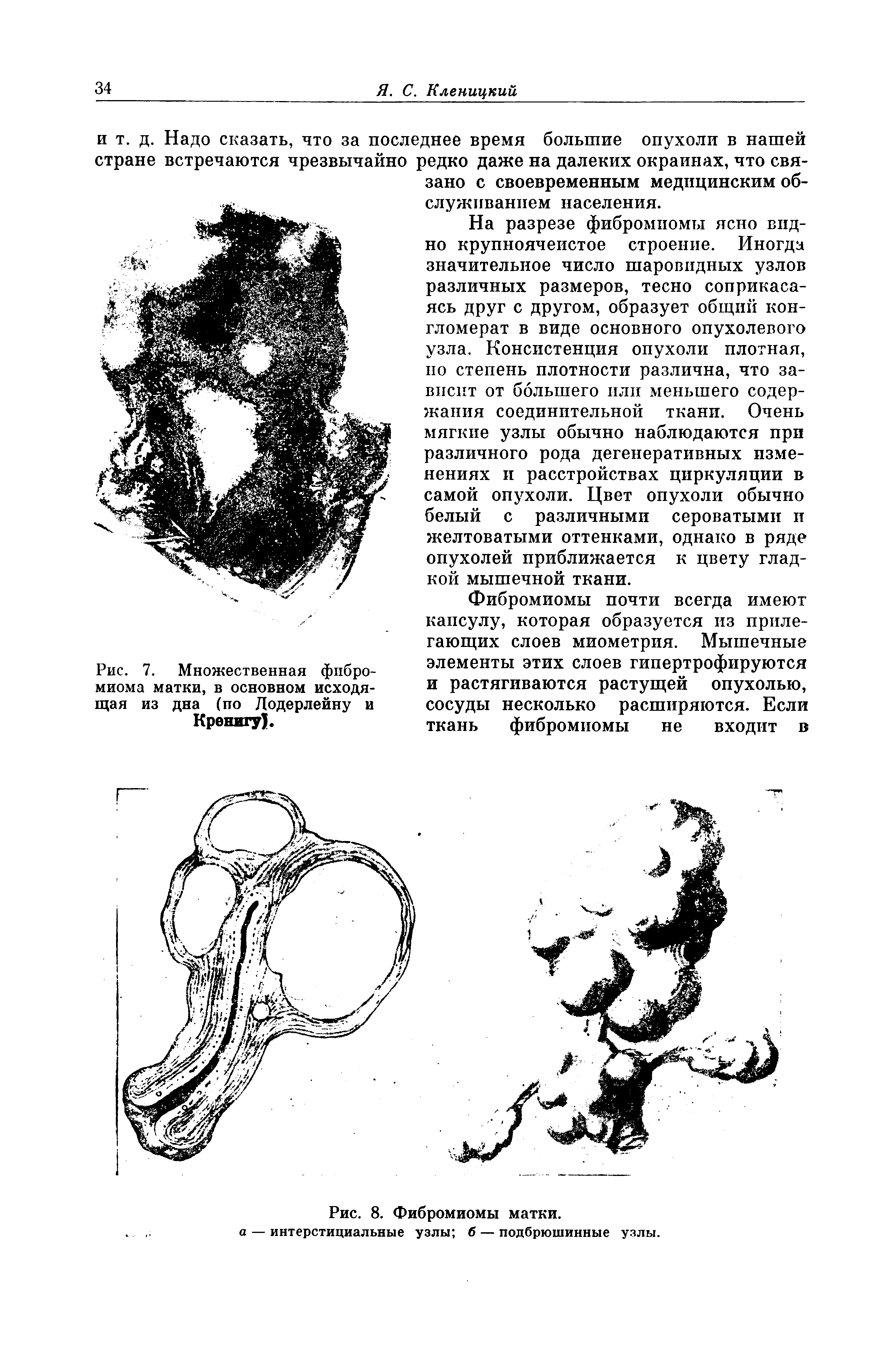 Рис. 7. Множественная фибромиома матки, в основном исходящая из дна (по Додерлейну и...