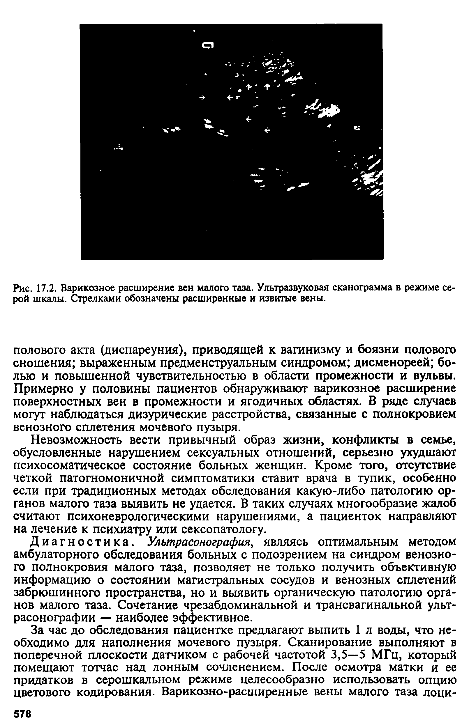 Рис. 17.2. Варикозное расширение вен малого таза. Ультразвуковая сканограмма в режиме серой шкалы. Стрелками обозначены расширенные и извитые вены.