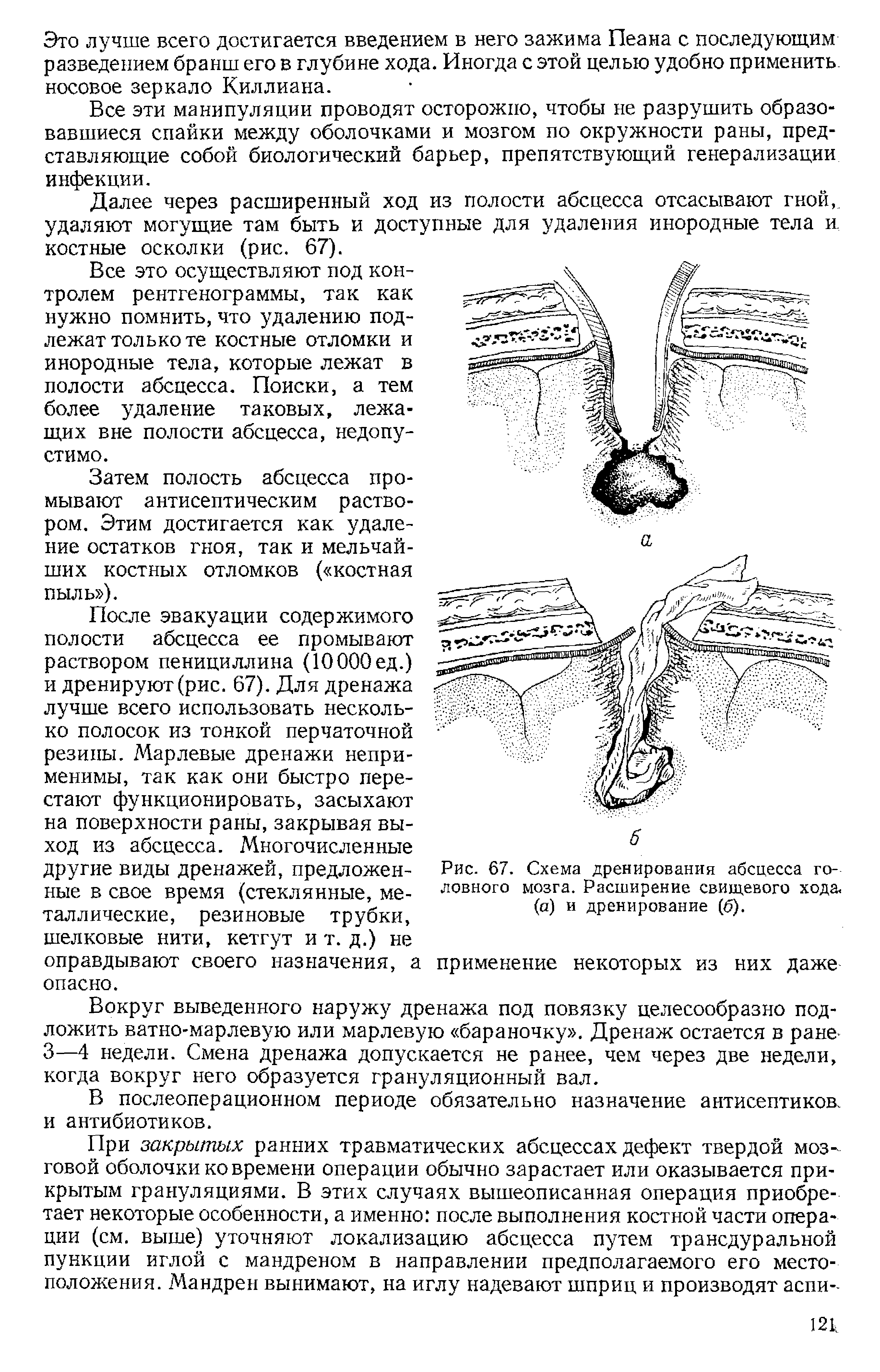 Рис. 67. Схема дренирования абсцесса головного мозга. Расширение свищевого хода.