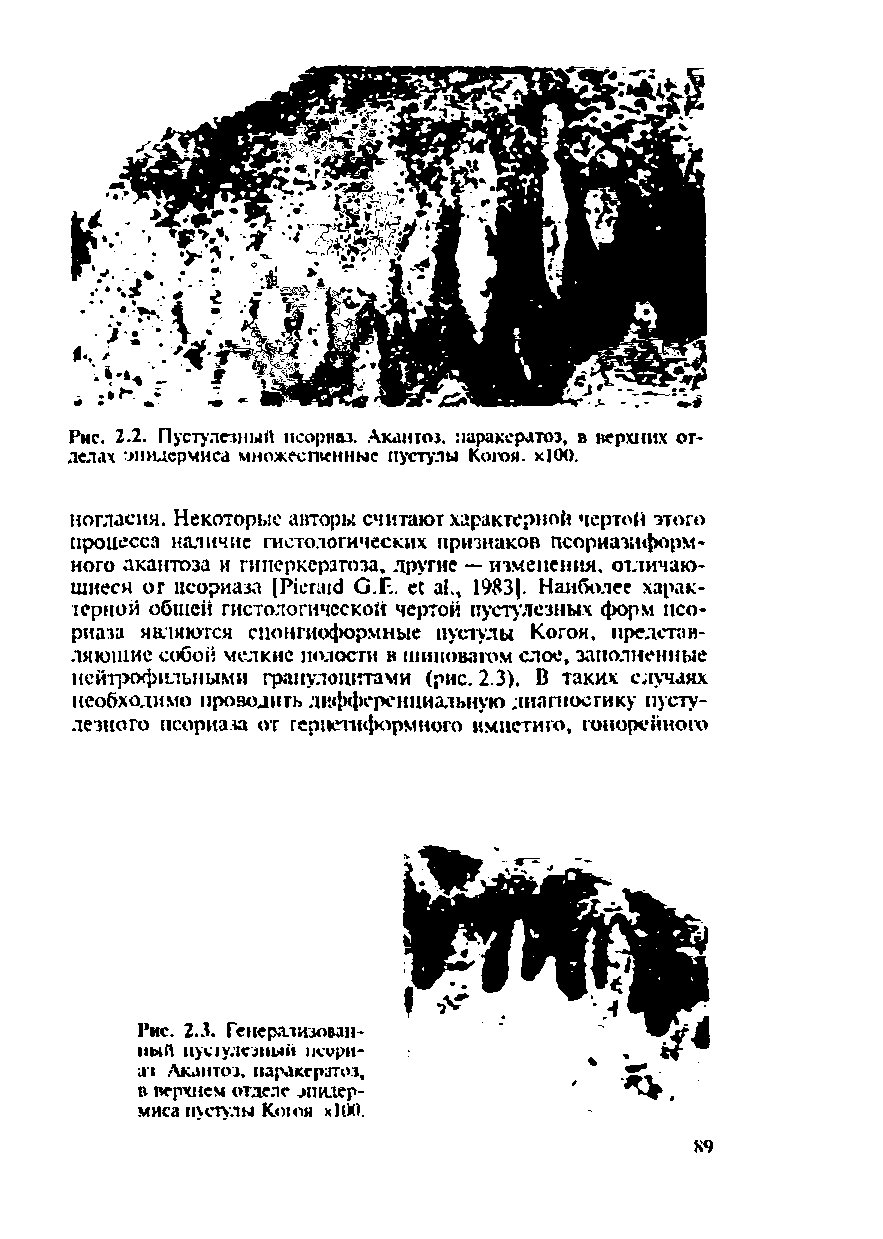 Рис. 2.3. Генерализованный . H -аз Лкантоз. паракерзтоз, в верхнем отделе эпидермиса пустулы Когоя хЮО.