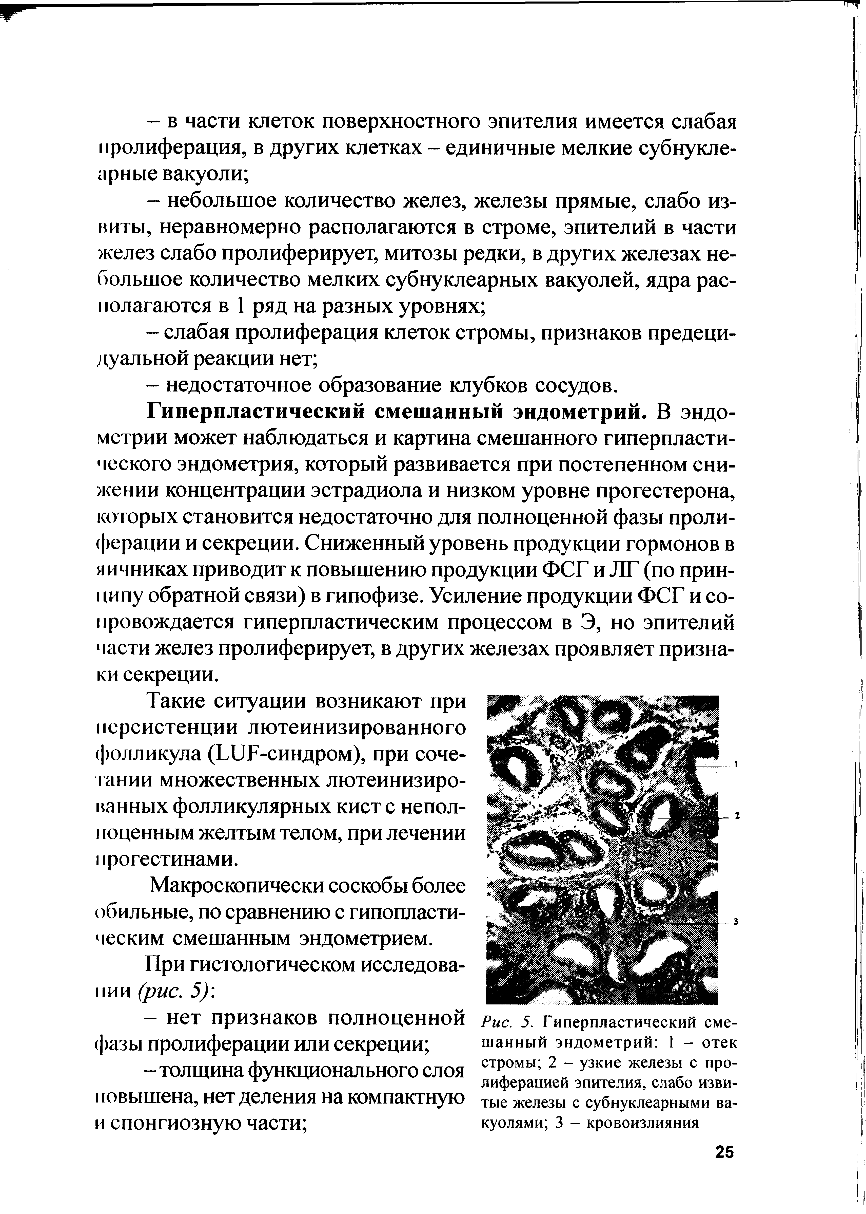 Рис. 5. Гиперпластический смешанный эндометрий 1 - отек стромы 2 - узкие железы с пролиферацией эпителия, слабо извитые железы с субнуклеарными вакуолями 3 - кровоизлияния...