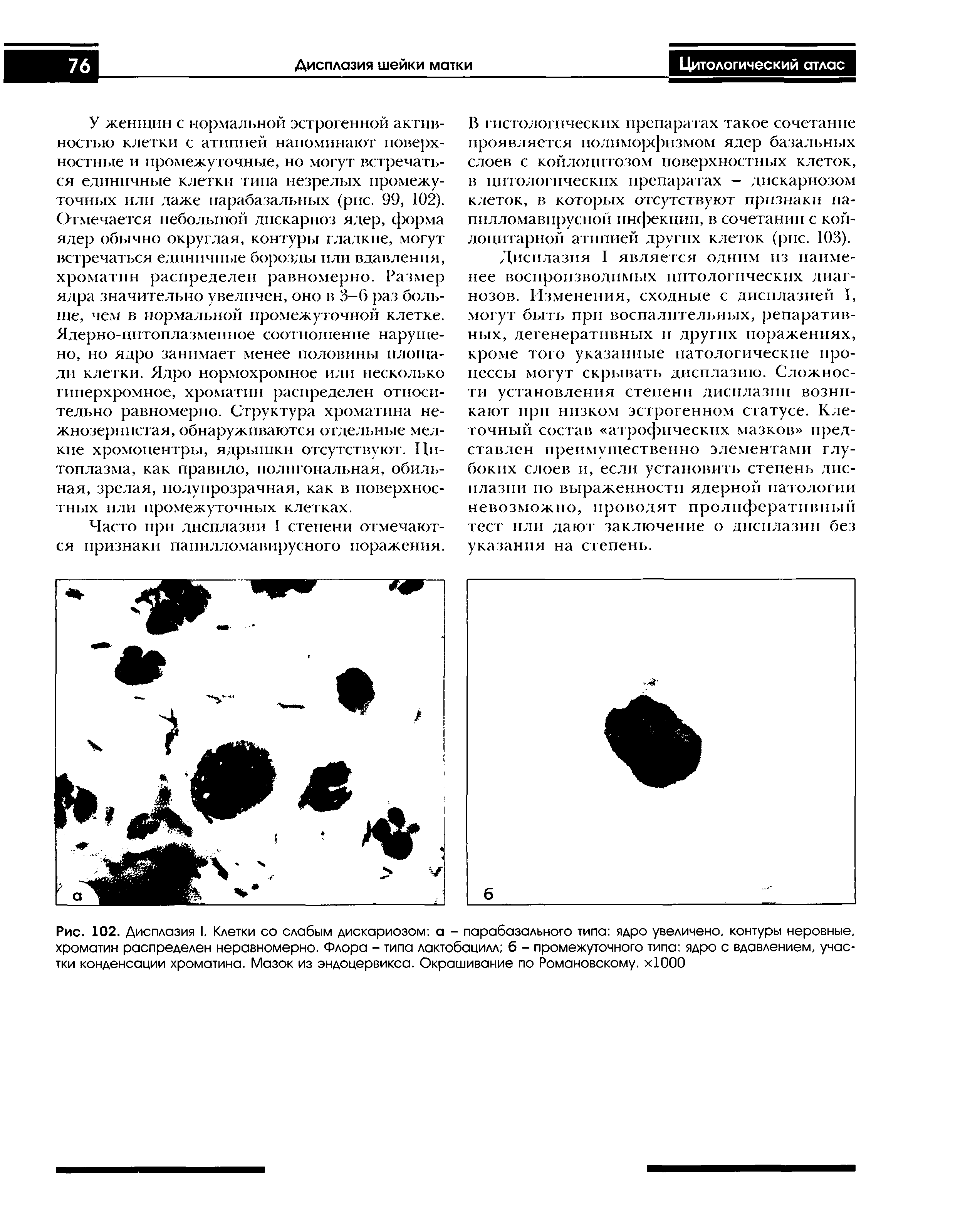 Рис. 102. Дисплазия I. Клетки со слабым дискариозом а - парабазального типа ядро увеличено, контуры неровные, хроматин распределен неравномерно. Флора - типа лактобацилл б - промежуточного типа ядро с вдавлением, участки конденсации хроматина. Мазок из эндоцервикса. Окрашивание по Романовскому. хЮОО...