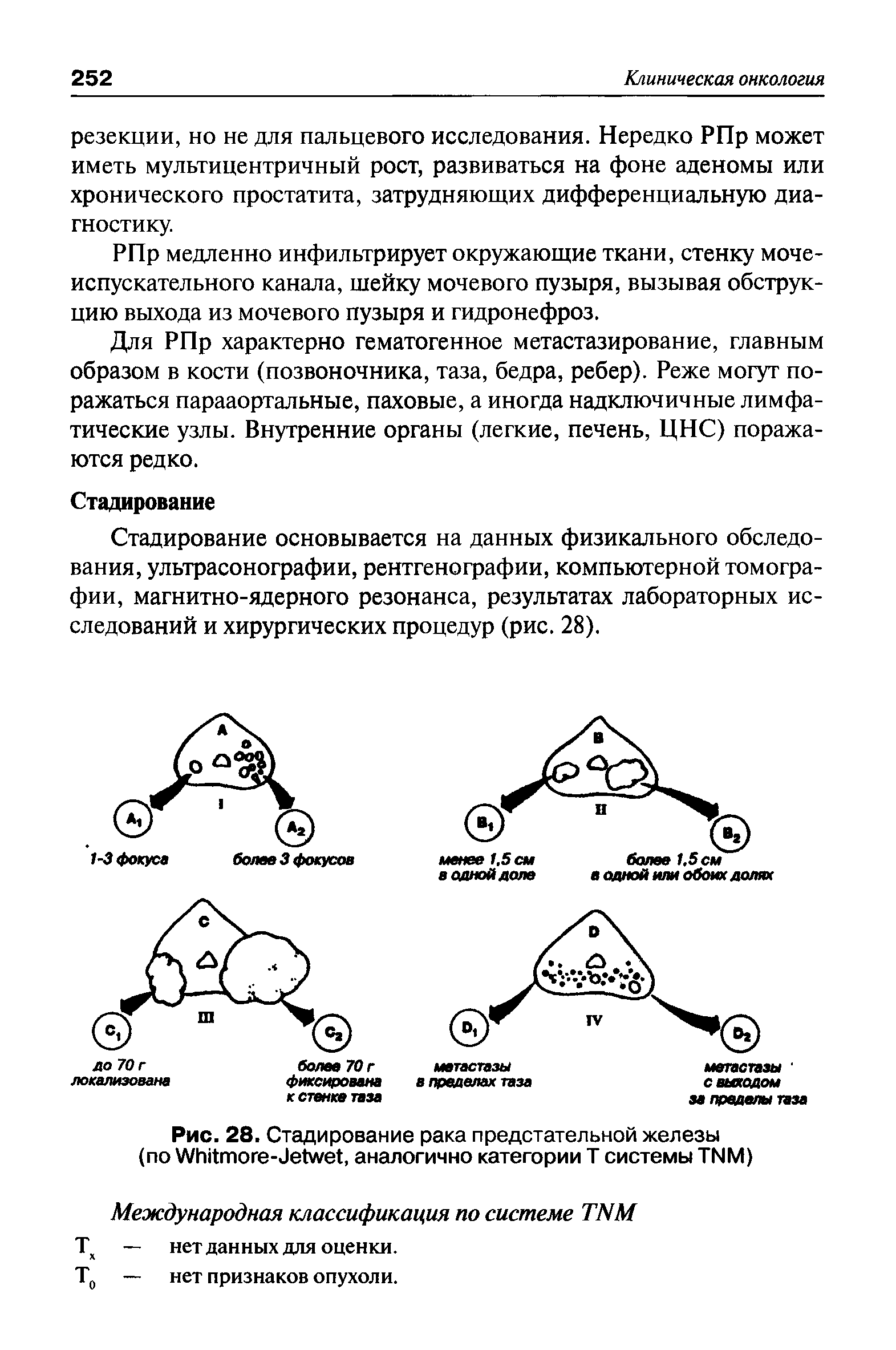 Рис. 28. Стадирование рака предстательной железы (по УУбйтоге-иеЬме , аналогично категории Т системы ТИМ)...