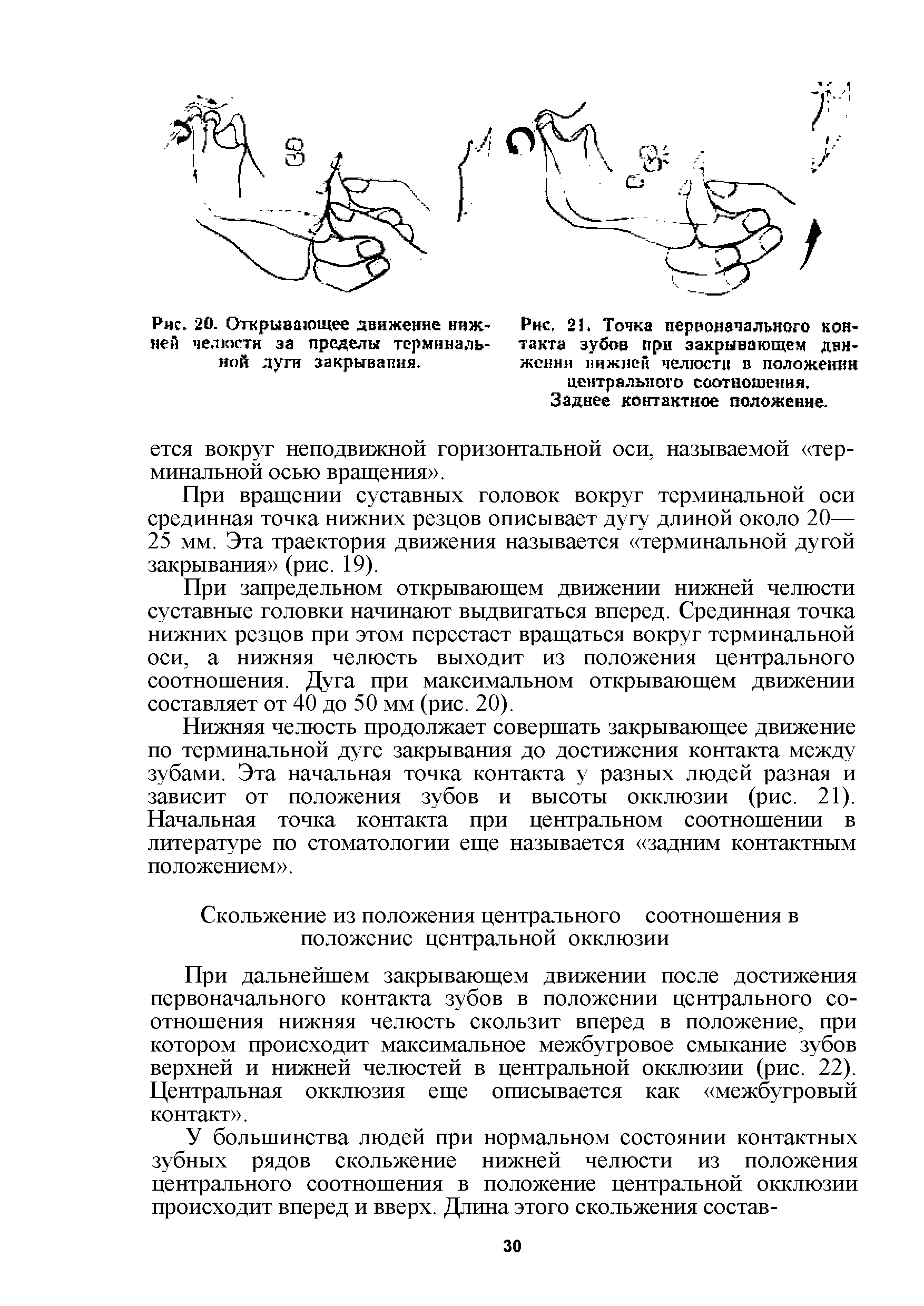 Рис. 21. Точка первоначального контакта зубов при закрывающем движении инжнен челюсти в положения центрального соотношения. Заднее контактное положе ине.