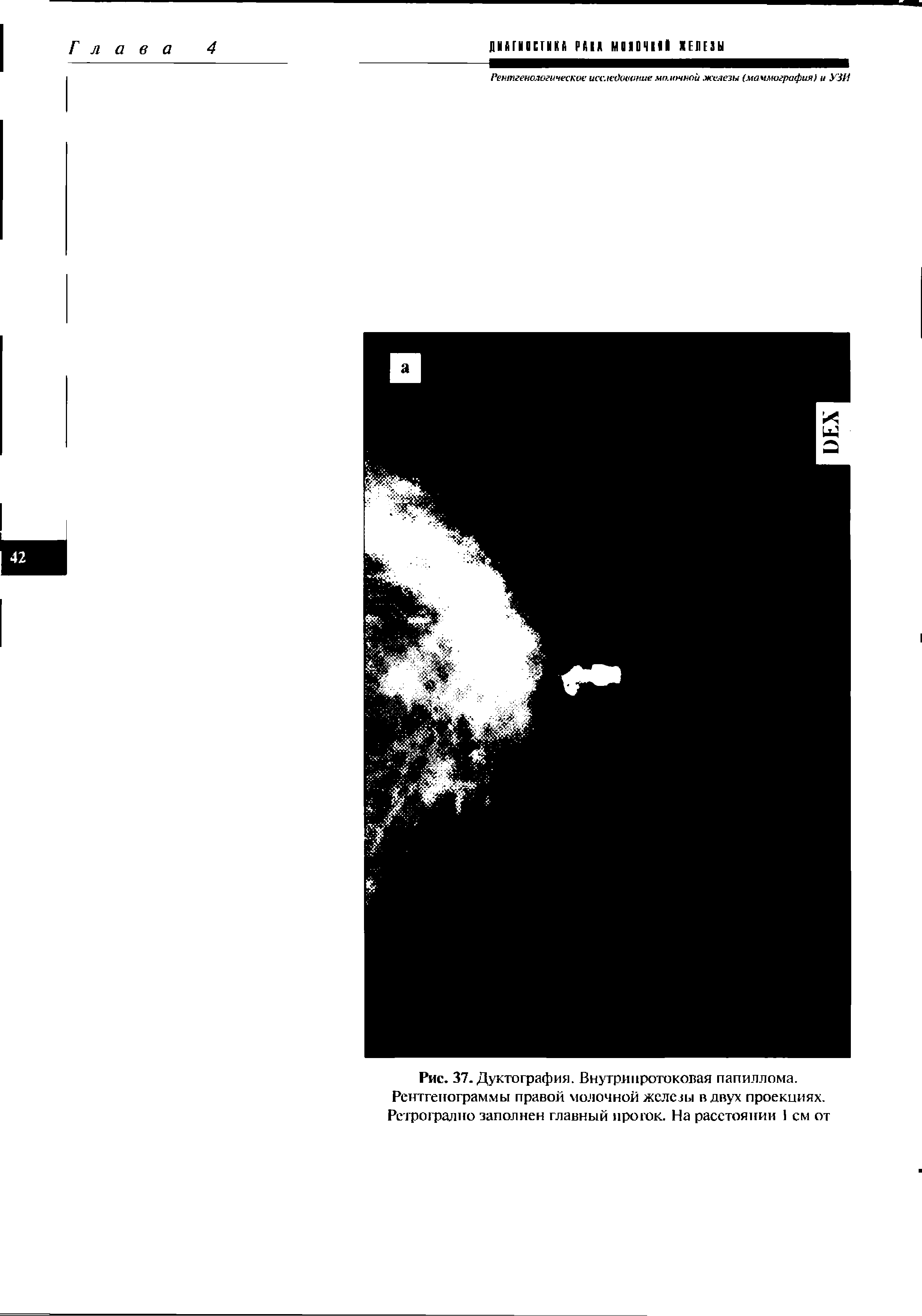 Рис. 37. Дуктография. Внутрипротоковая папиллома. Рентгенограммы правой молочной железы в двух проекциях. Ретроградно заполнен главный проток. На расстоянии 1 см от...