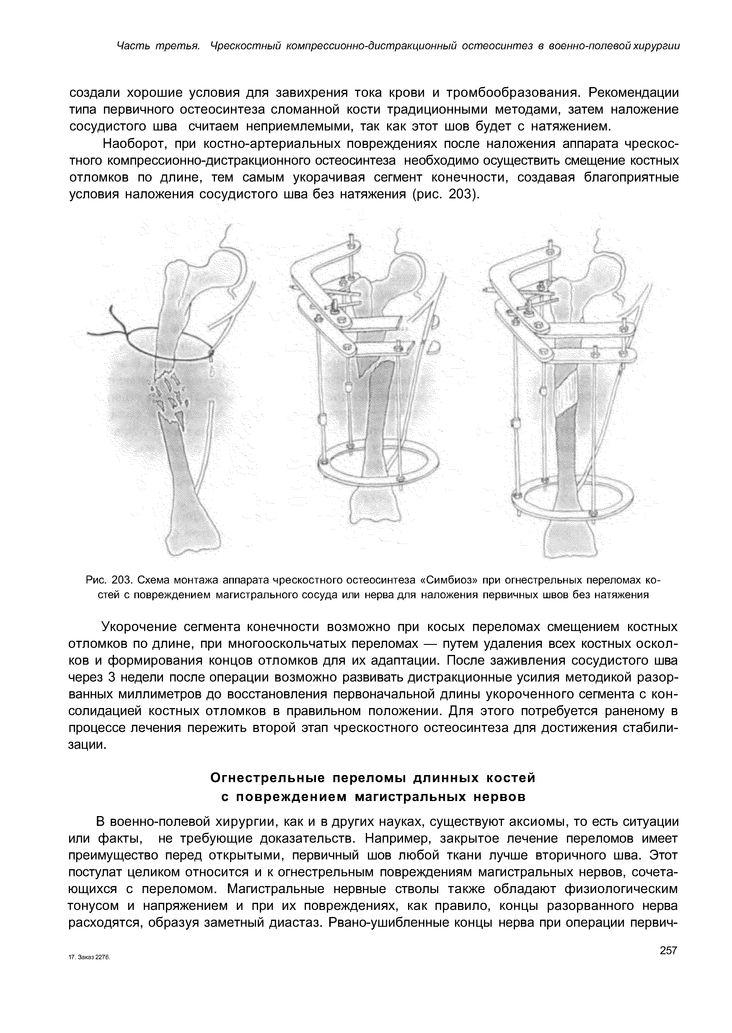 Рис. 203. Схема монтажа аппарата чрескостного остеосинтеза Симбиоз при огнестрельных переломах костей с повреждением магистрального сосуда или нерва для наложения первичных швов без натяжения...