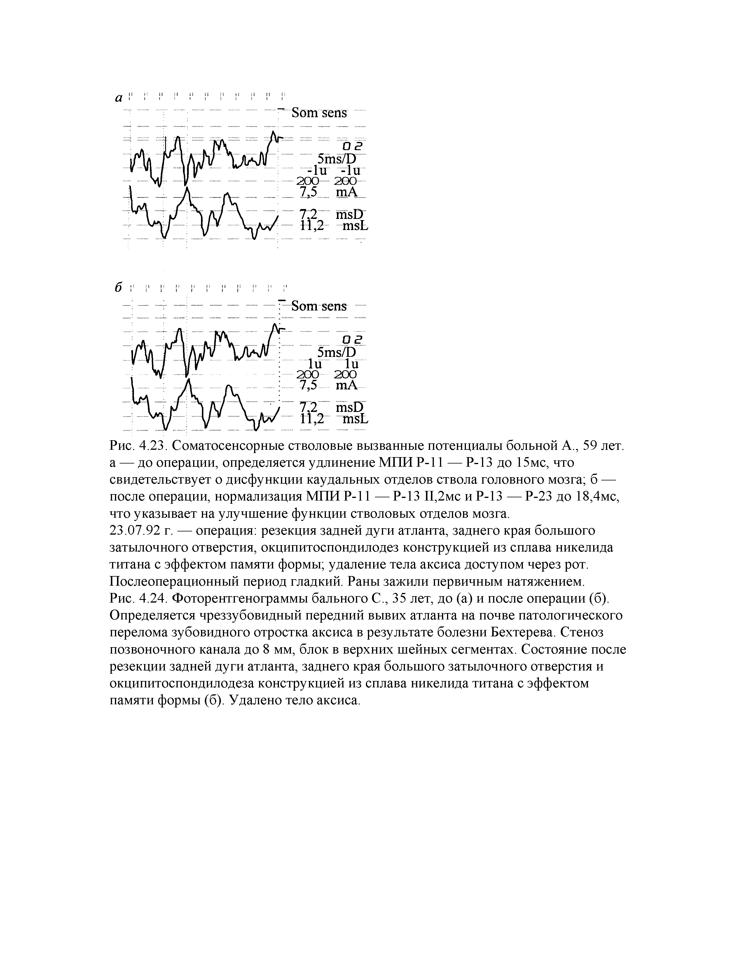 Рис. 4.23. Соматосенсорные стволовые вызванные потенциалы больной А., 59 лет. а — до операции, определяется удлинение МПИ Р-11 — Р-13 до 15мс, что свидетельствует о дисфункции каудальных отделов ствола головного мозга б — после операции, нормализация МПИ Р-11 — Р-13 П,2мс и Р-13 — Р-23 до 18,4мс, что указывает на улучшение функции стволовых отделов мозга.