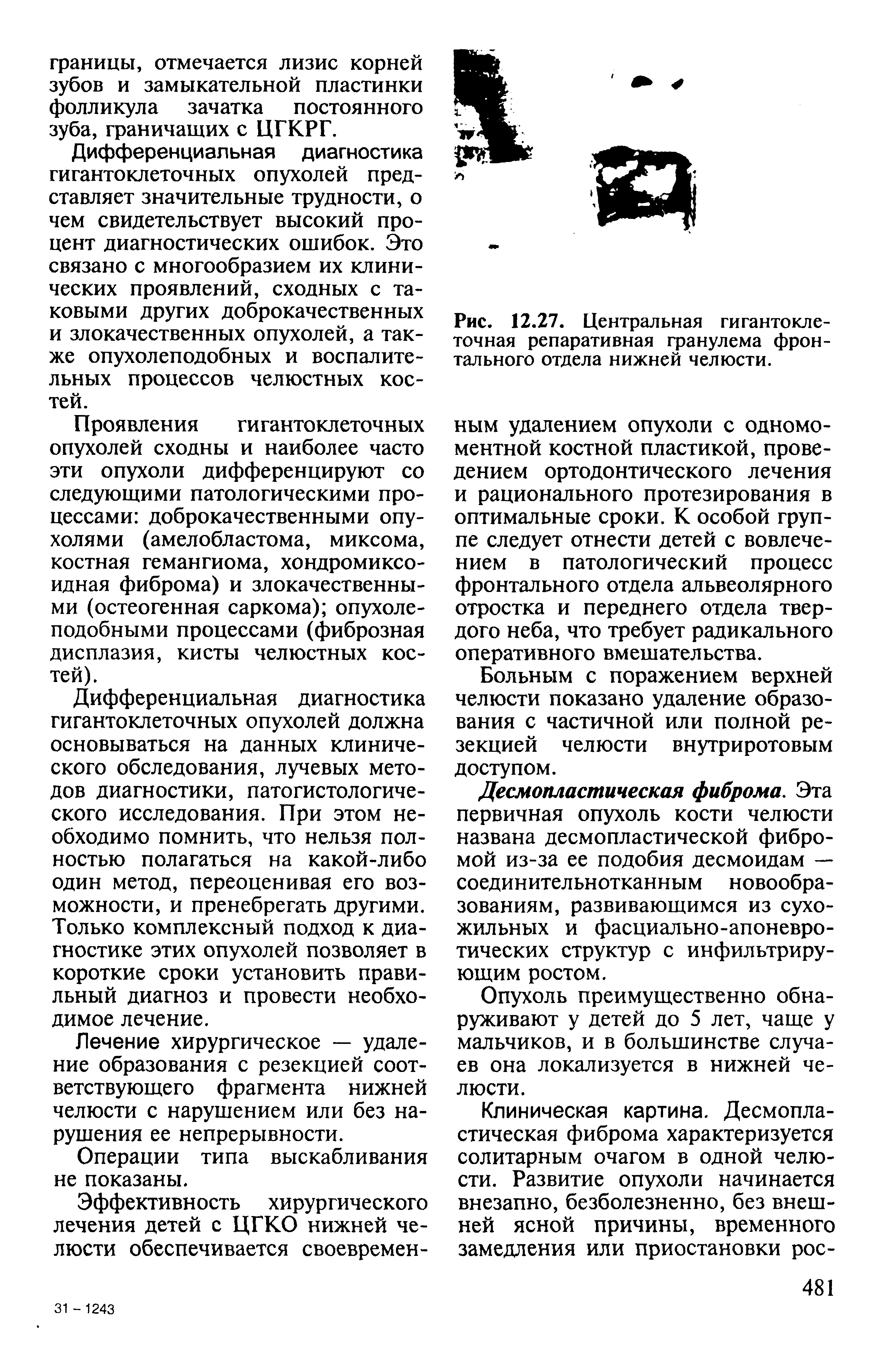 Рис. 12.27. Центральная гигантоклеточная репаративная гранулема фронтального отдела нижней челюсти.