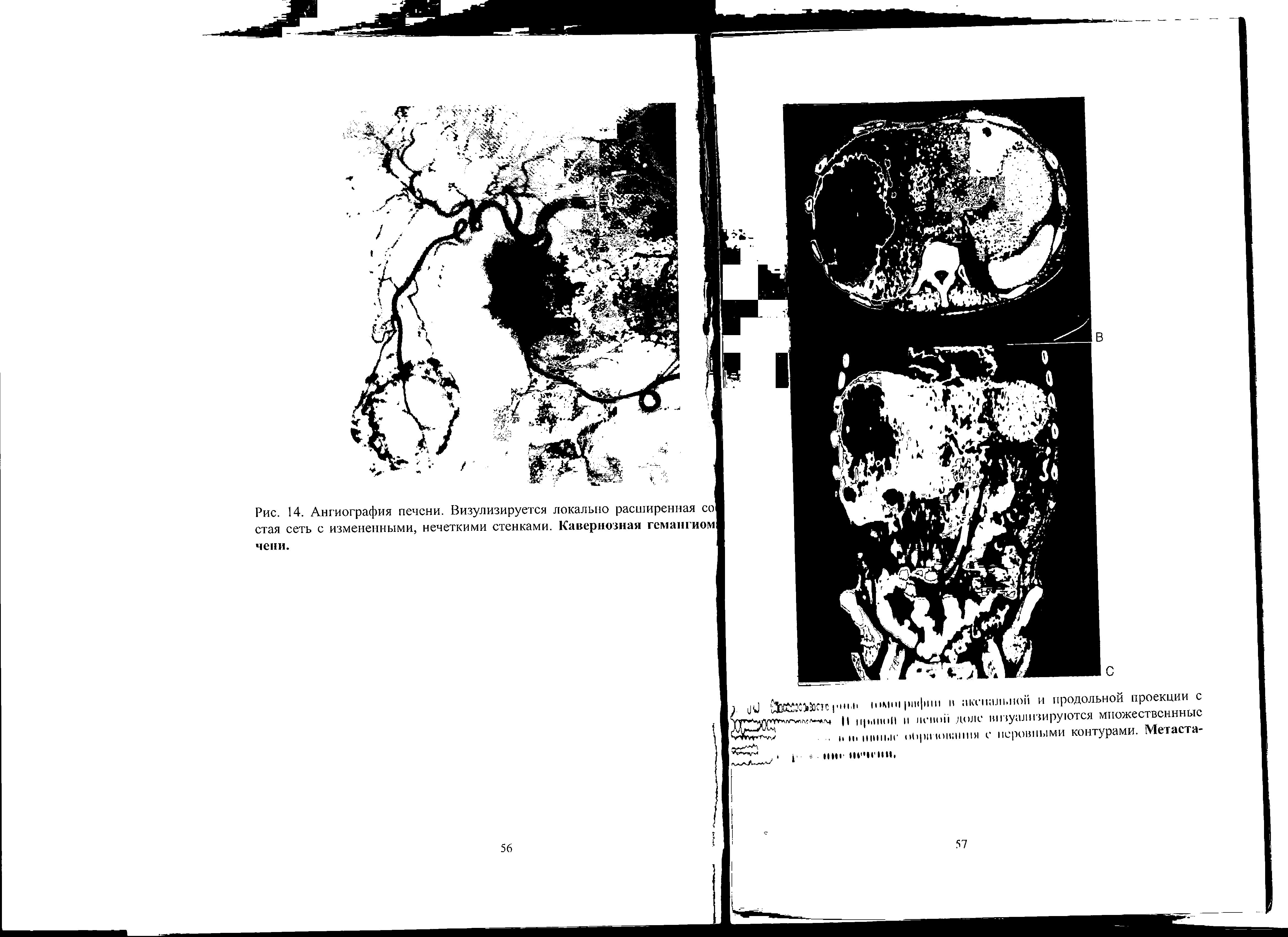 Рис. 14. Ангиография печени. Визулизируется локально расширенная стая сеть с измененными, нечеткими стенками. Кавернозная гемангиом...