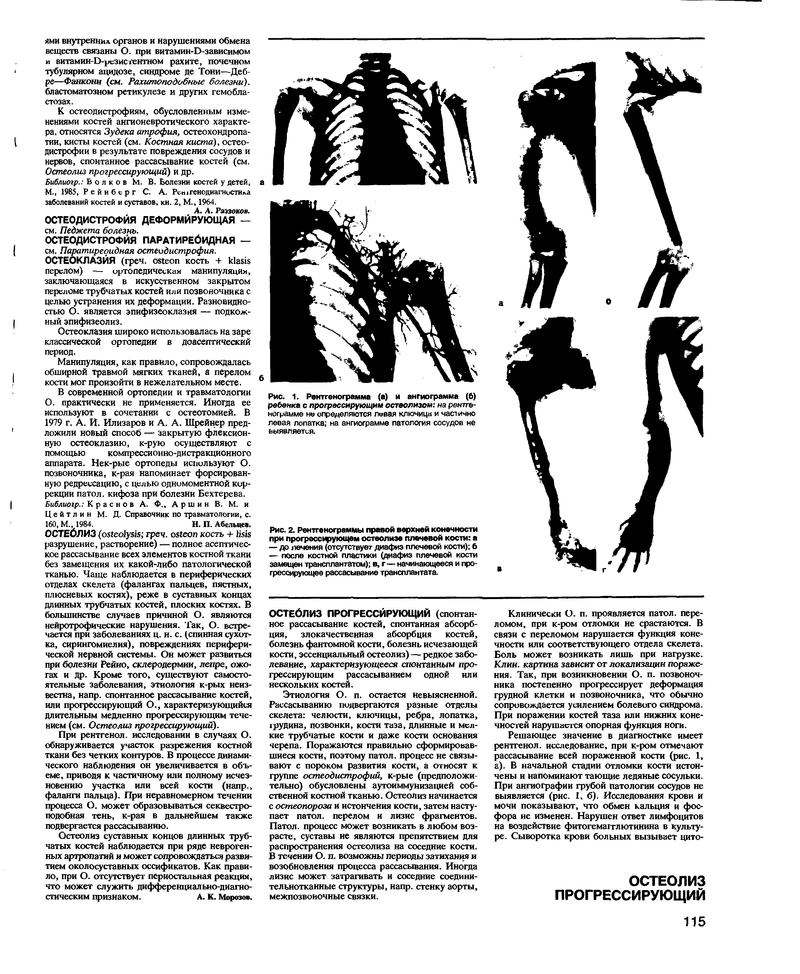 Рис. 1. Рентгенограмма (а) и ангиограмма (6) ребенка с прогрессирующим остеолизом на рентгенограмме не определяются левая ключица и частично левая лопатка на ангиограмме патология сосудов не выявляется.