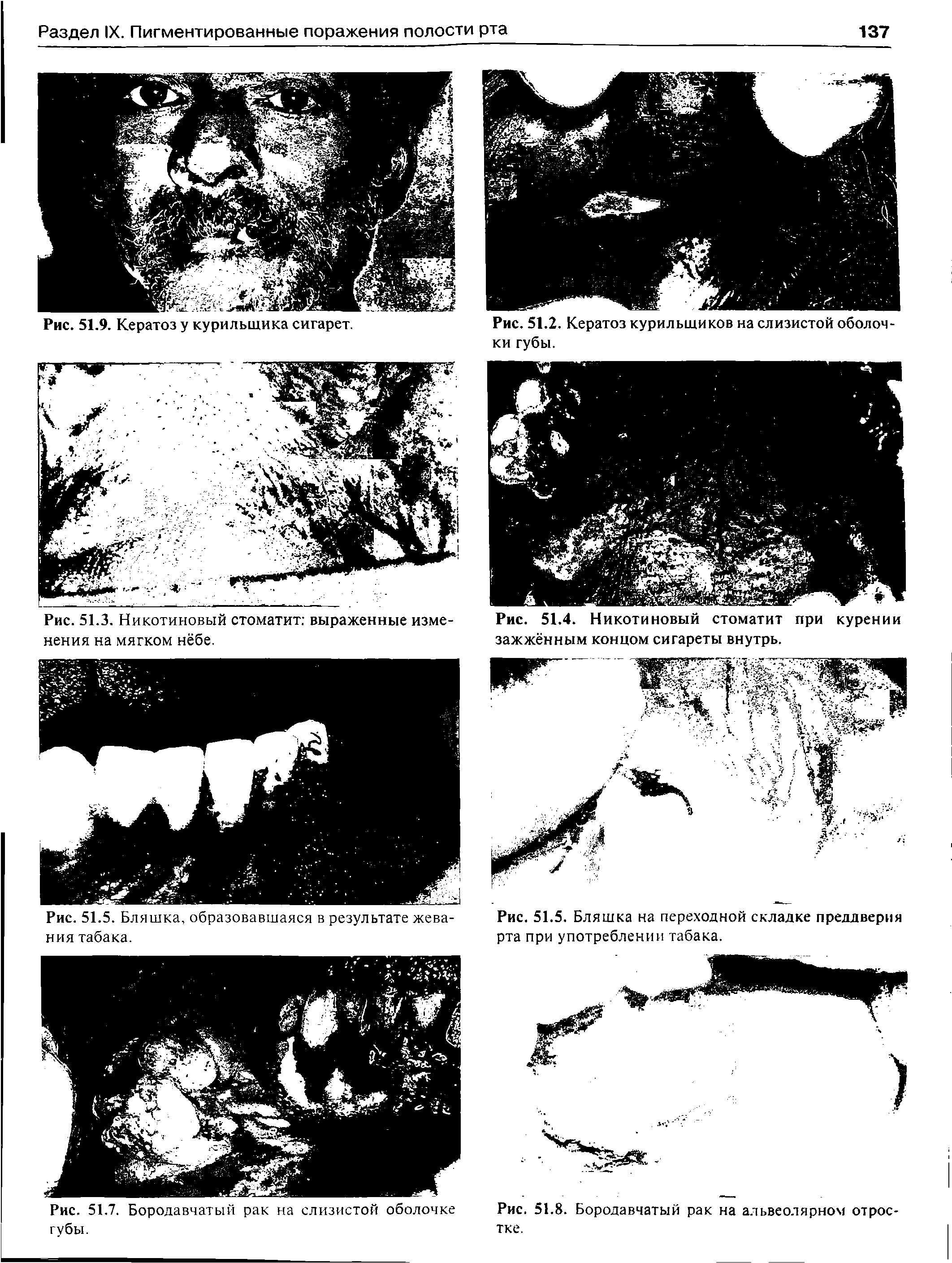 Рис. 51.4. Никотиновый стоматит при курении зажжённым концом сигареты внутрь.